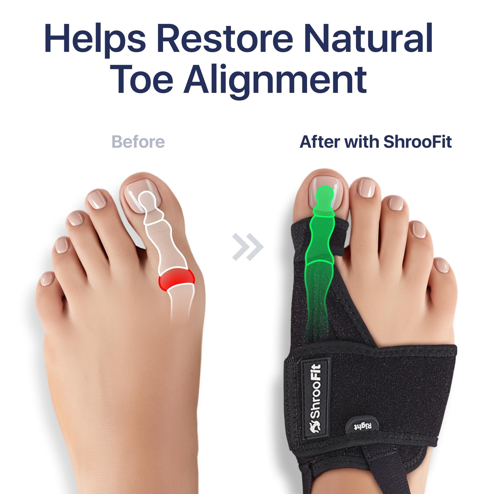 ShrooFit Effective Bunion Corrector for Women and Men | Relieve Pain, Straighten Toes, and Correct Bunions | Orthopedic Toe Straightener | Best Bunion Corrector for Lasting Relief
