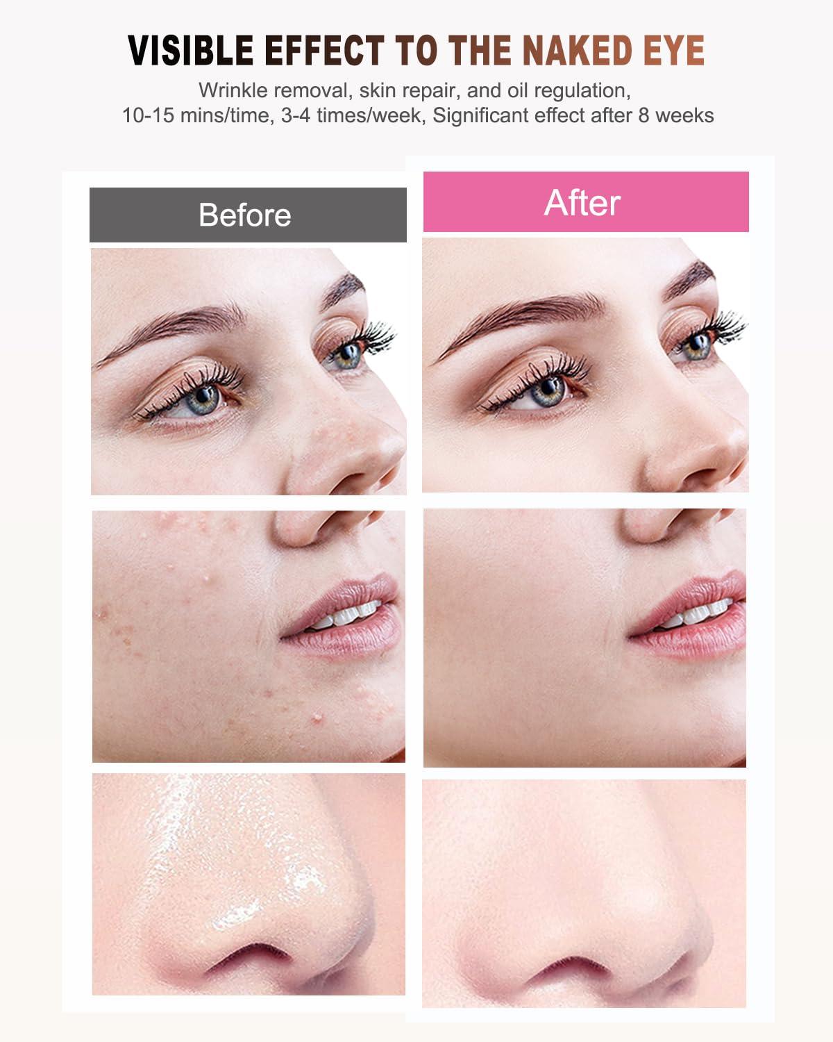 BETNEP Red Light Therapy for Face,3 Modes LED Face Mask Light Therapy,Near-Infrared 850 Red Light Therapy Mask(NIR),Portable,Rechargeable and Remote