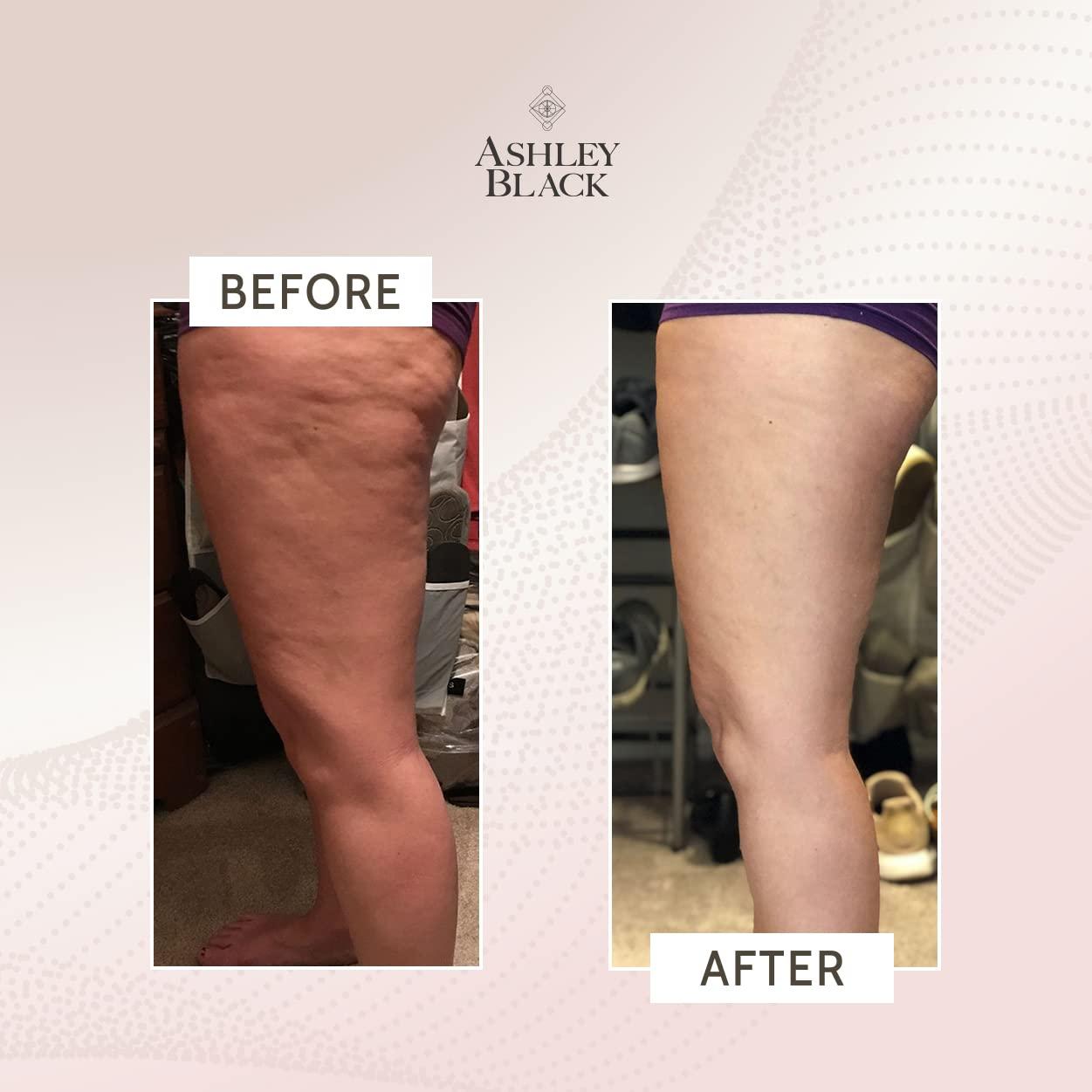 FasciaBlaster FasciaBlaster The ProBlaster Handheld by Ashley Black. Scientifcally Proven MyoFascial Tools. Gentle Massage with Effective Results. Releive Full Body Tension and Anti-Cellulite