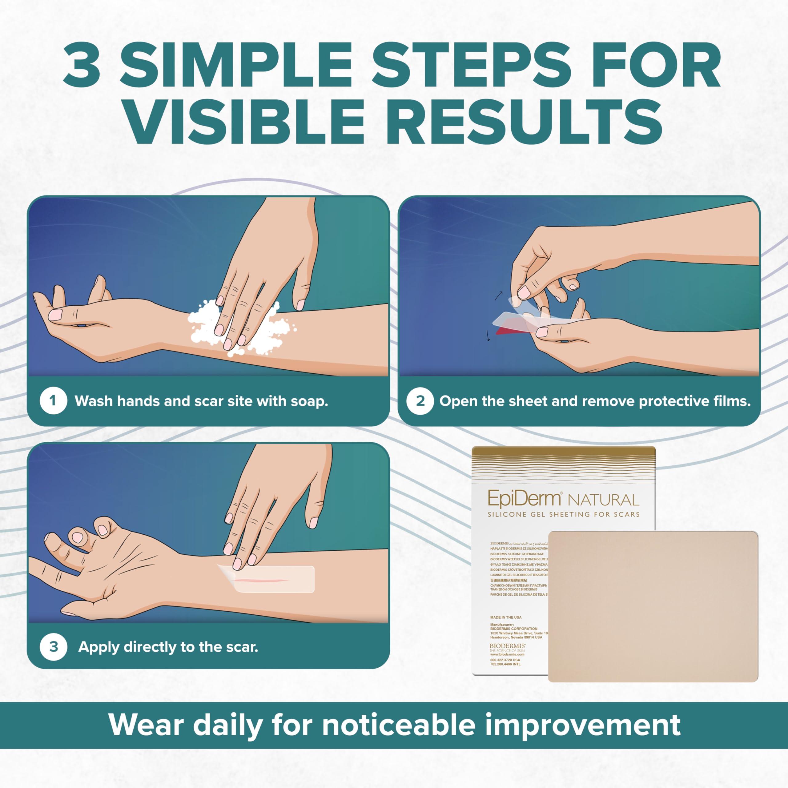 BIODERMIS Epi-Derm Large Sheets, Premium Grade Silicone Scar Sheets for C-Section, Tummy Tuck, Hysterectomy & Cardiac Surgery Scars, Easy To Use & Reusable Silicone Gel Sheets for Scars, 11 x 15.75 in - Natural