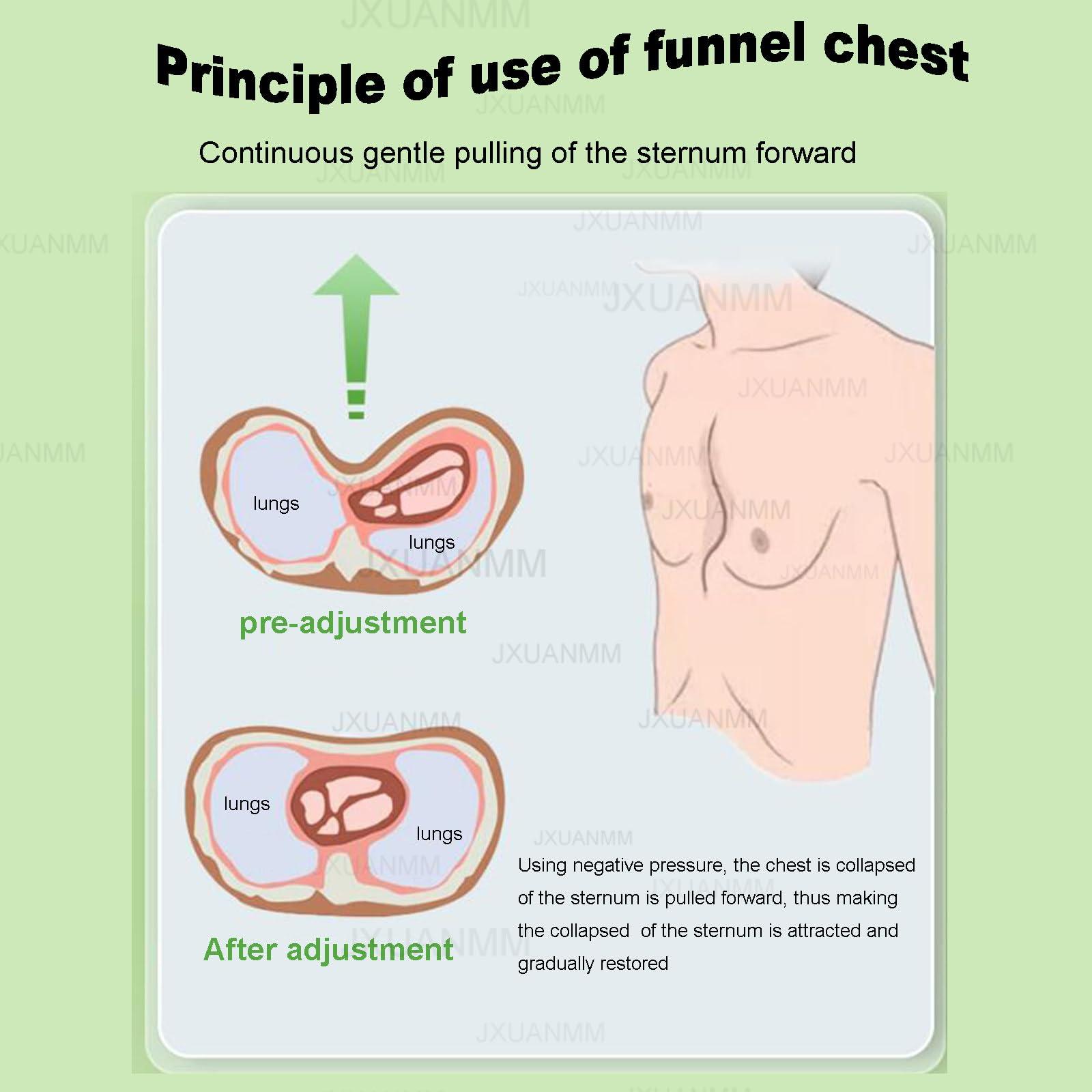 JXUANMM JXUANMM Pectus Excavatum Orthosis Brace,Pectus Excavatum Vacuum Bell - Pectus Excavatum Orthosis Brace,Chest Support,with Pressure Gauge,S