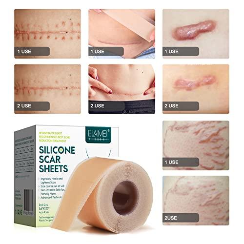 Moulis Silicone Scar Sheets (1.6” x 120” Roll-3M), Silicone Scar Tape Roll, Scar Silicone Strips, Reusable, Professional Scar Removal Sheets for C-Section, Surgery, Burn, Keloid, Acne et