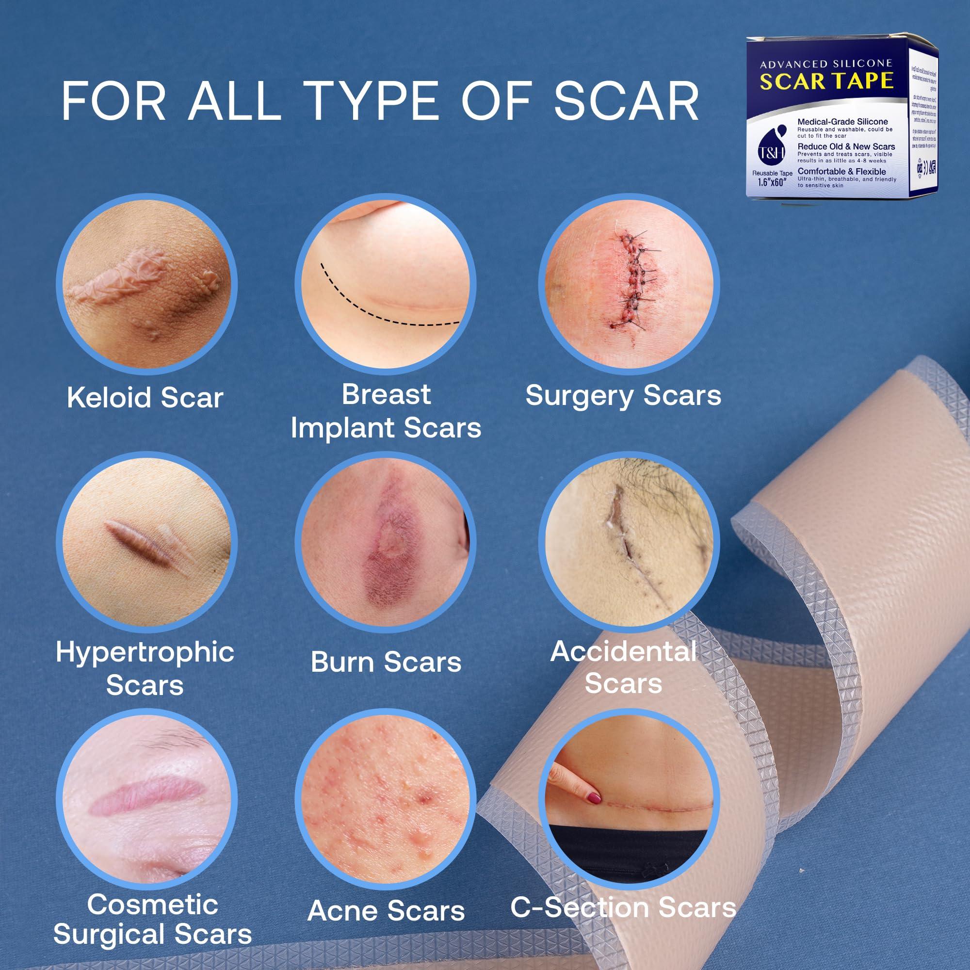 TEREZ & HONOR Advanced Silicone Scar Sheets Tape - Medical Grade Soft Silicone Gel Scar Sheets Tape, Highly Comfortable Painless for C-Section, Stretch Marks, Acne, Surgery, Effective Scars Treatment Tapes