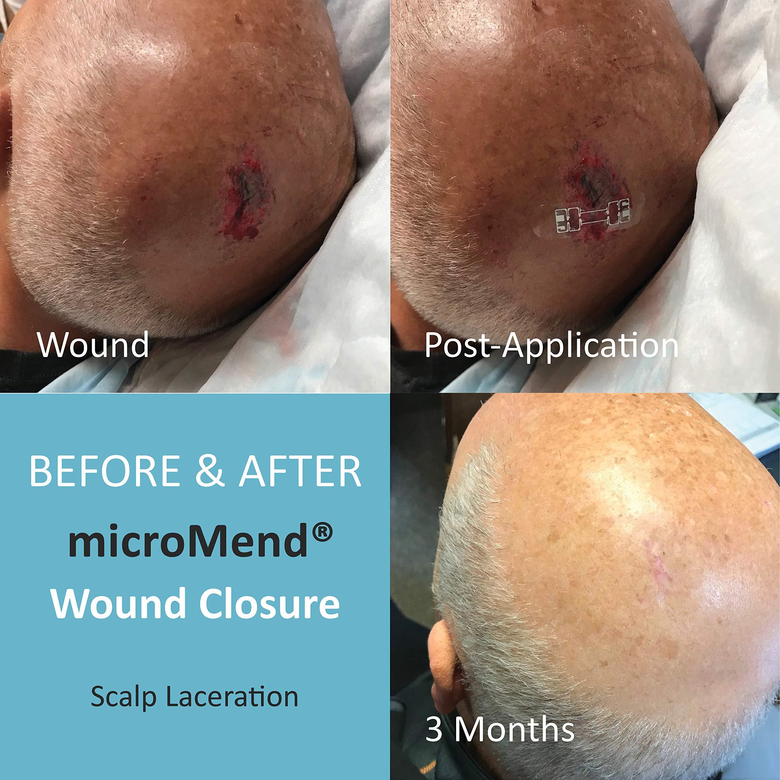 microMend microMend Emergency Wound Closures Surgical Quality Laceration Repair Without Stitches - Think Ahead - Be Prepared - Add to Your Survival Kit, Camping Gear (Multi Pack - 3 Packs of 2 Medium Devices)