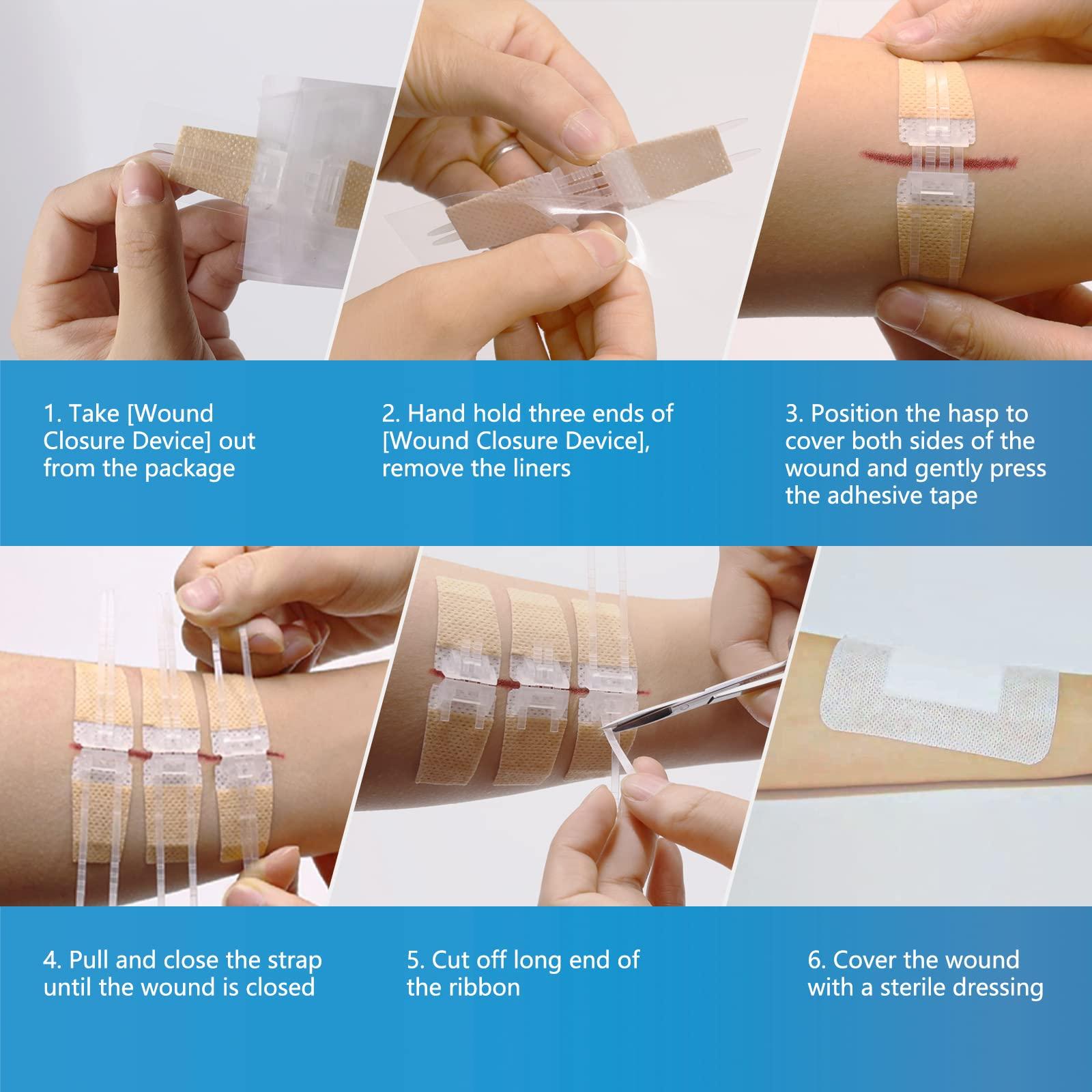 SEABIRD Zip Stitch Wound Closure Kit, Butterfly Bandages,Quick Clot for Easy Use, Surgical Quality,Emergency Laceration Closures Strips, Suture-Free Surgical Repairment, First Aid Wound Care (Yellow, 6)