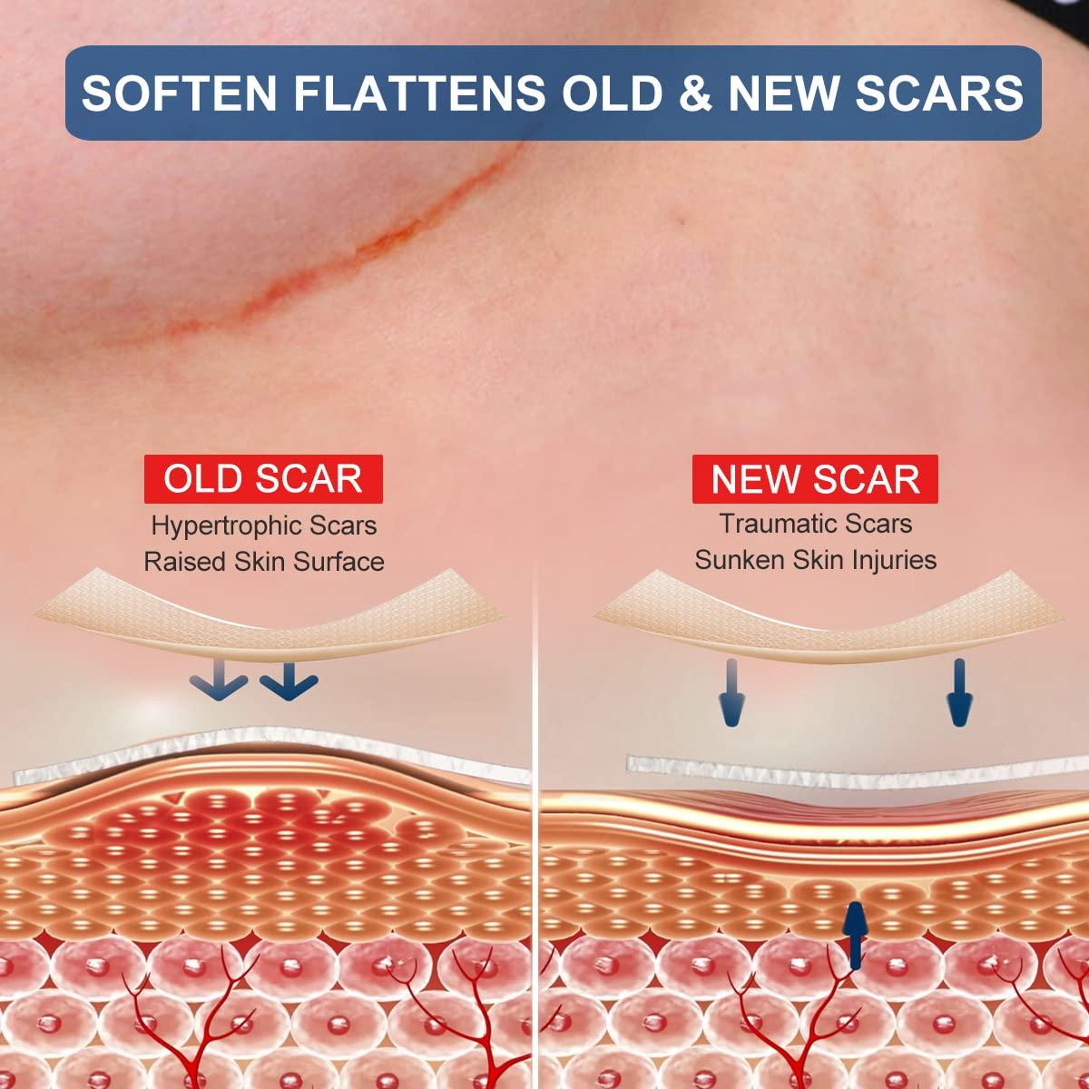 ZODENIS Silicone Scar Sheets, Silicone Scar Sheets for Breast 8 Pack, Breast Reduction After Surgery for Scars, Scar Removal Sheets, 4 Areola Soft Strips & 4 Anchor Sheets