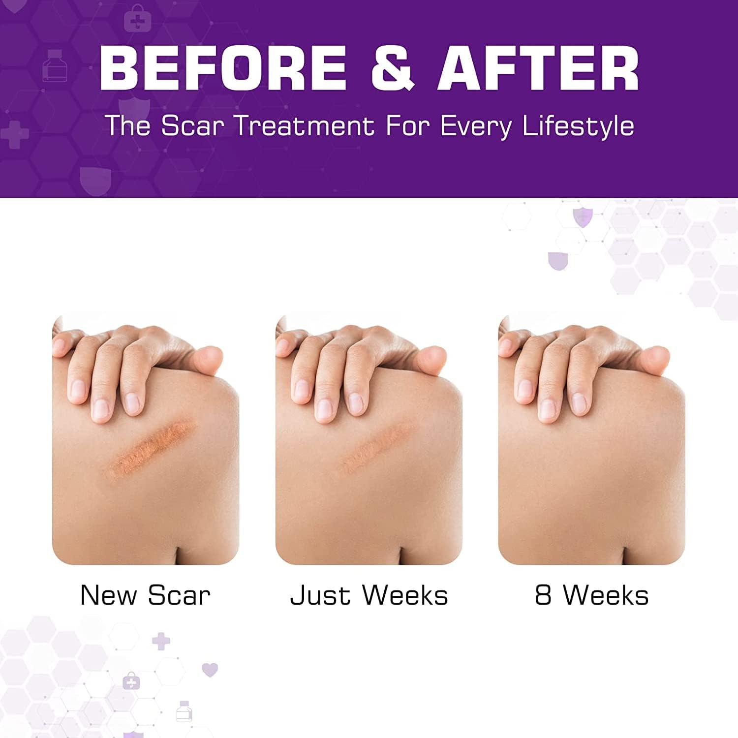 Kelinul Silicone Scar Sheets(1.6\'\' x 60\'\'Roll-1.5M) - Soft Silicone Gel Scar Tape Painless Silicone Tape Roll - Reusable, Medical Grade Silicone Scar Removal Strips for C-Sectio