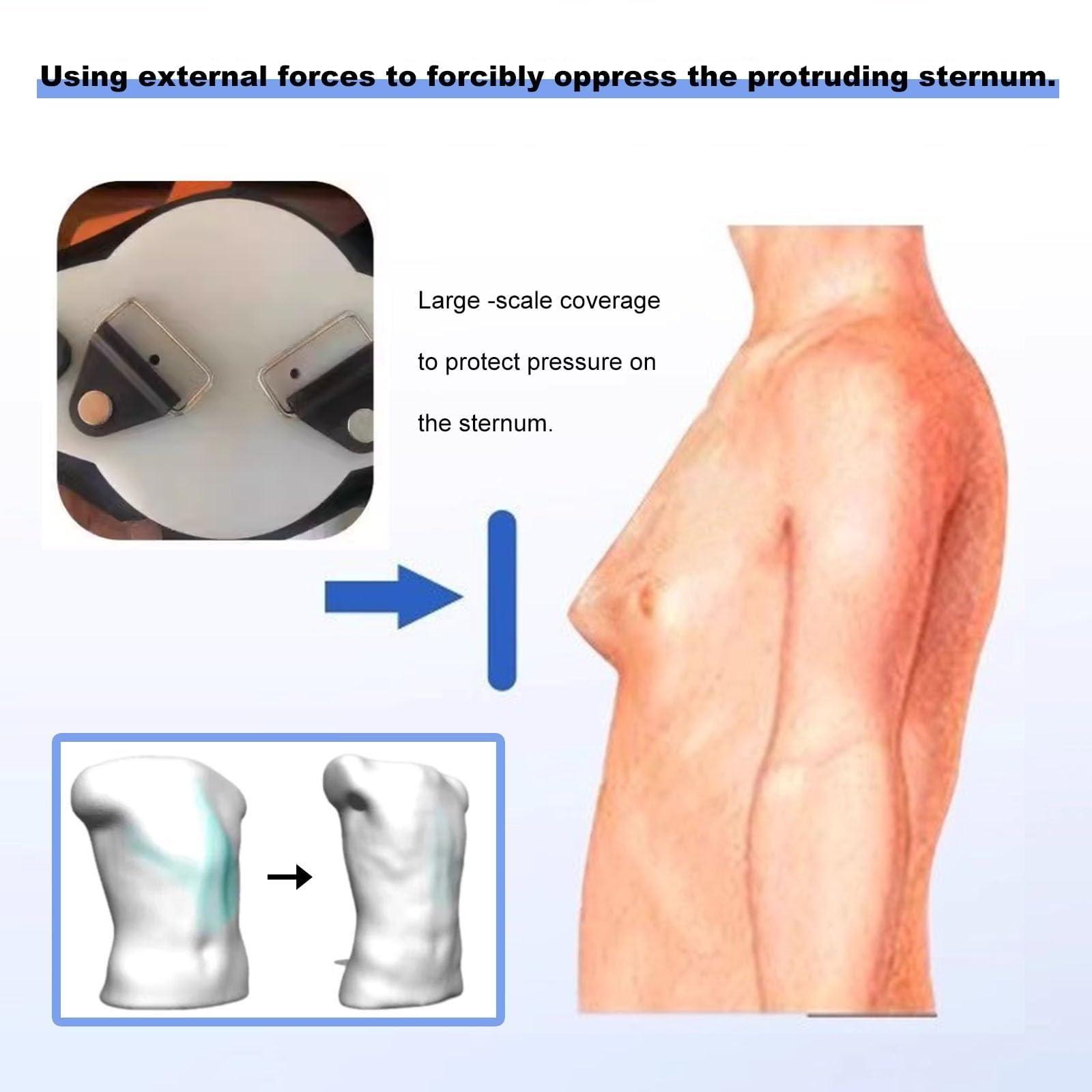 NICHOY NICHOY Pectus Carinatum Orthosis Brace - Deformed Sternum Brace,Pigeon Chest Support for All Ages,Ribs Valgus Orthosis Braces,Adjustable Size,Suitable for All Body Types(Adult)