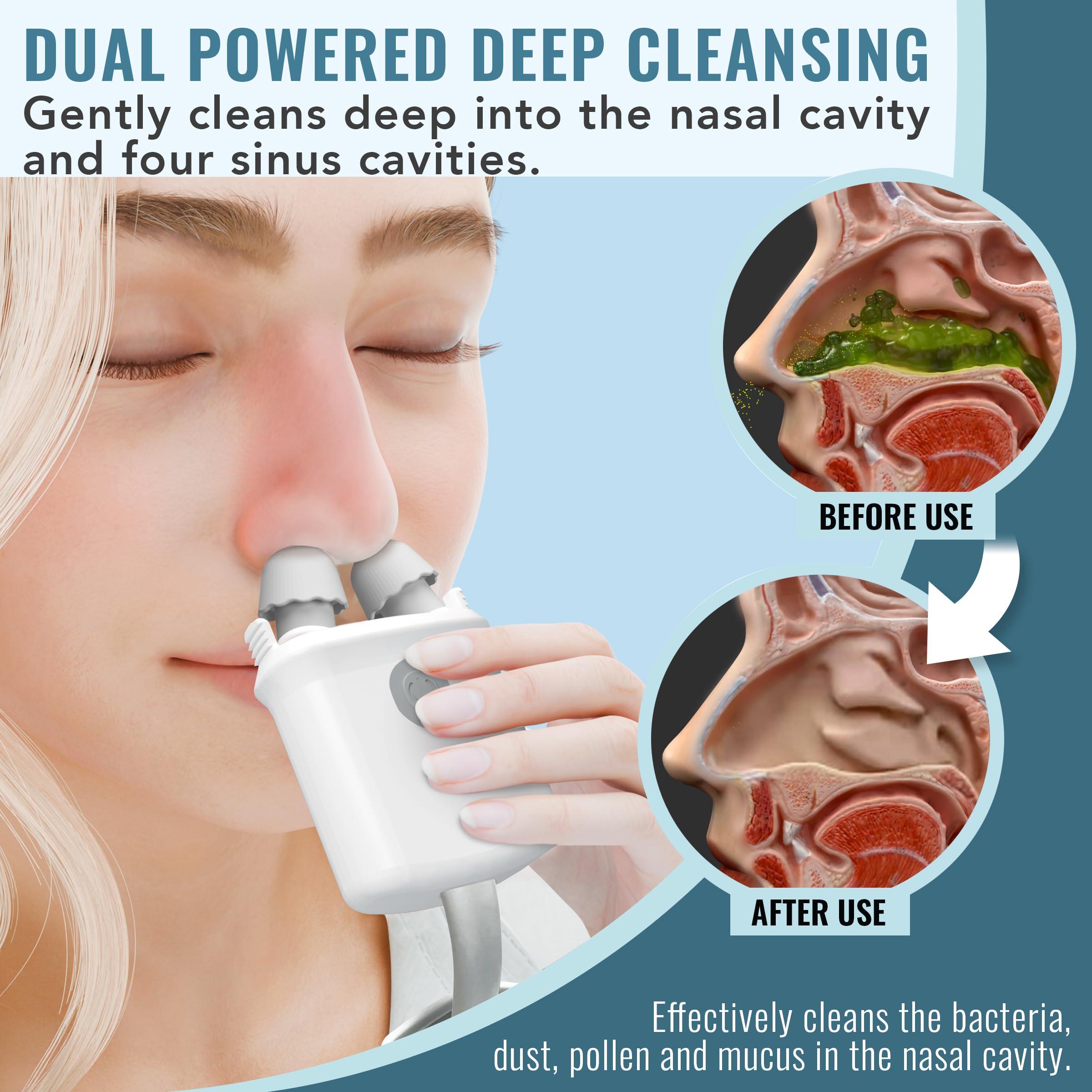 SPA SCIENCES NASALFRESH MD - Dual Powered Nasal Irrigation System Nasal Rinse and Wash - Sinus Decongestant Relief System w/ 30 Saline Packets - Rechargeable - Snoring Remedy