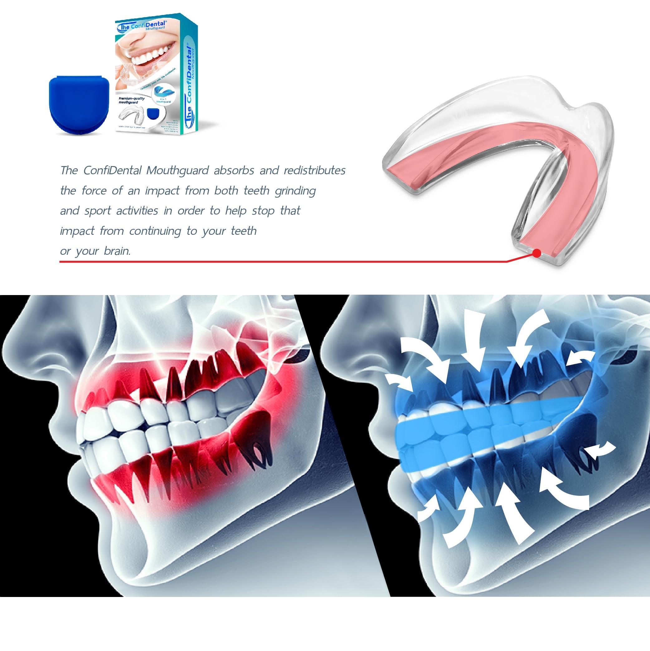 The ConfiDental The ConfiDental Mouth Guard for Grinding Teeth at Night - Model for Small Mouth Pack of 6 Moldable Dental Night Guards for Teeth Grinding and Clenching Teeth Grinding Mouth Guard for Sleep