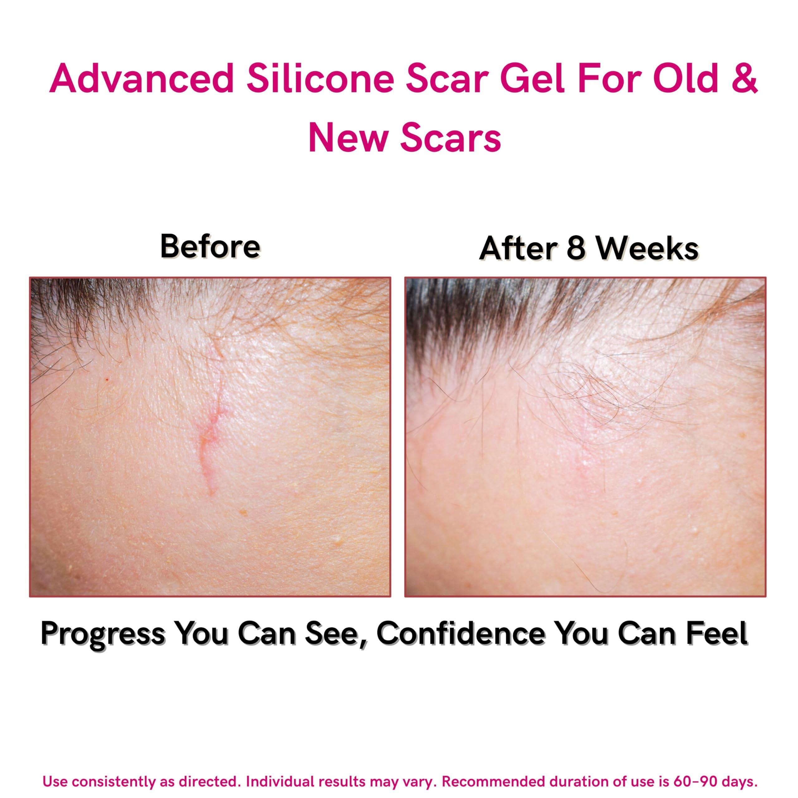 LIPOELASTIC LIPOELASTIC Silicone Scar Cream for Surgical Scars, Medical Grade Silicone Scar Gel with Vitamin E for C-Section, Burn, Stretch Marks, Wound, Old Scar, Acne Scar Treatment, Crema para Cicatrices