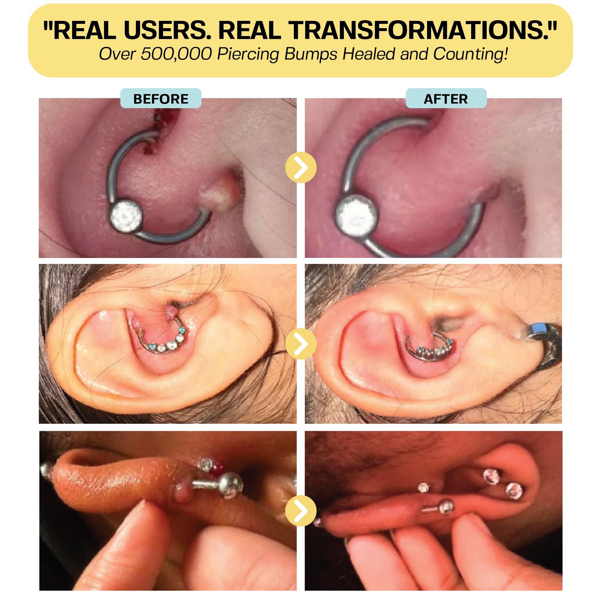 BASE LABORATORIES BASE LABORATORIES Keloid Bump Removal Gel | Natural Piercing Bump Treatment & Keloid Scar Gel | Keloid Scar Removal for All Scars, Keloids & Piercing Bumps | Soothing Piercing Aftercare Gel | 2 Pack