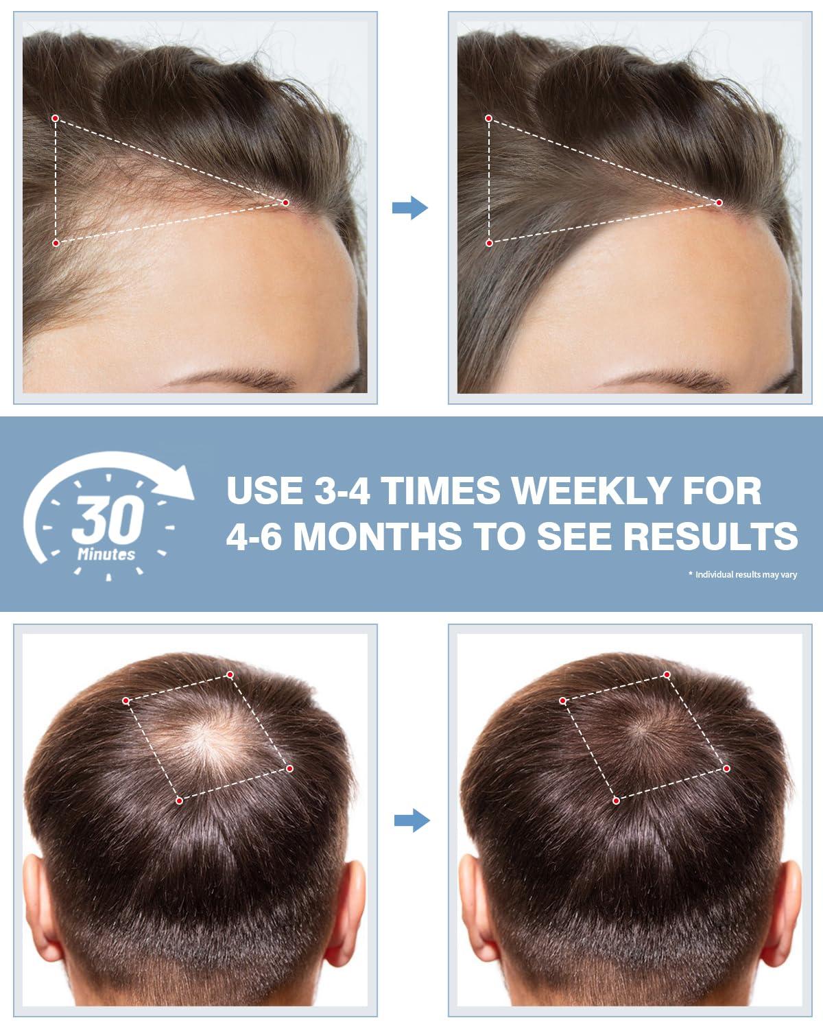 LONLIKE LONLIKE Light Therapy Hat, Red Light Cap for Head with Timer & Controller, Red Light 630nm Infrared Light 850nm 940nm Infrared Therapy Cap