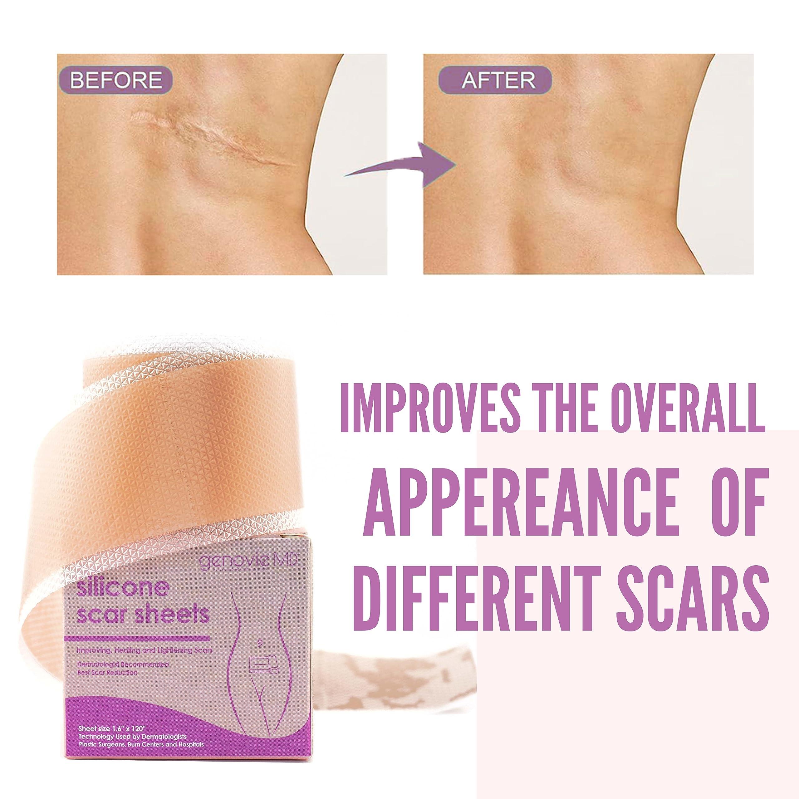 genovie MD Genovie MD Medical Grade Silicone Scar Sheets - Scar Tape Roll Treatment for C-Sections, Keloids, Acne, Post Operative Surgeries, Burns, 6 month Supply, Reusable and Removable Scar Sheets