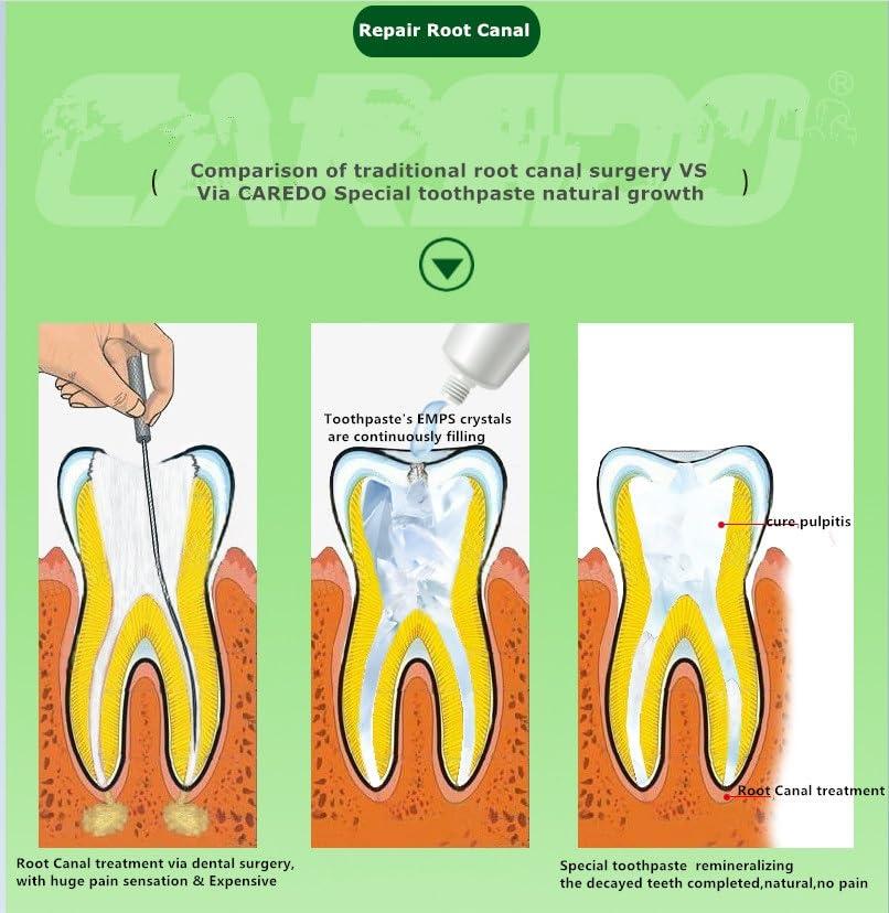 CAREDO CAREDO Gingivitis Toothpaste Avoid Root Canal Pulpitis for Adults, Gingivitis at Home, Gum for Receding Gums with Hydroxyapatite Toothpaste (100g+16g 2pcs)