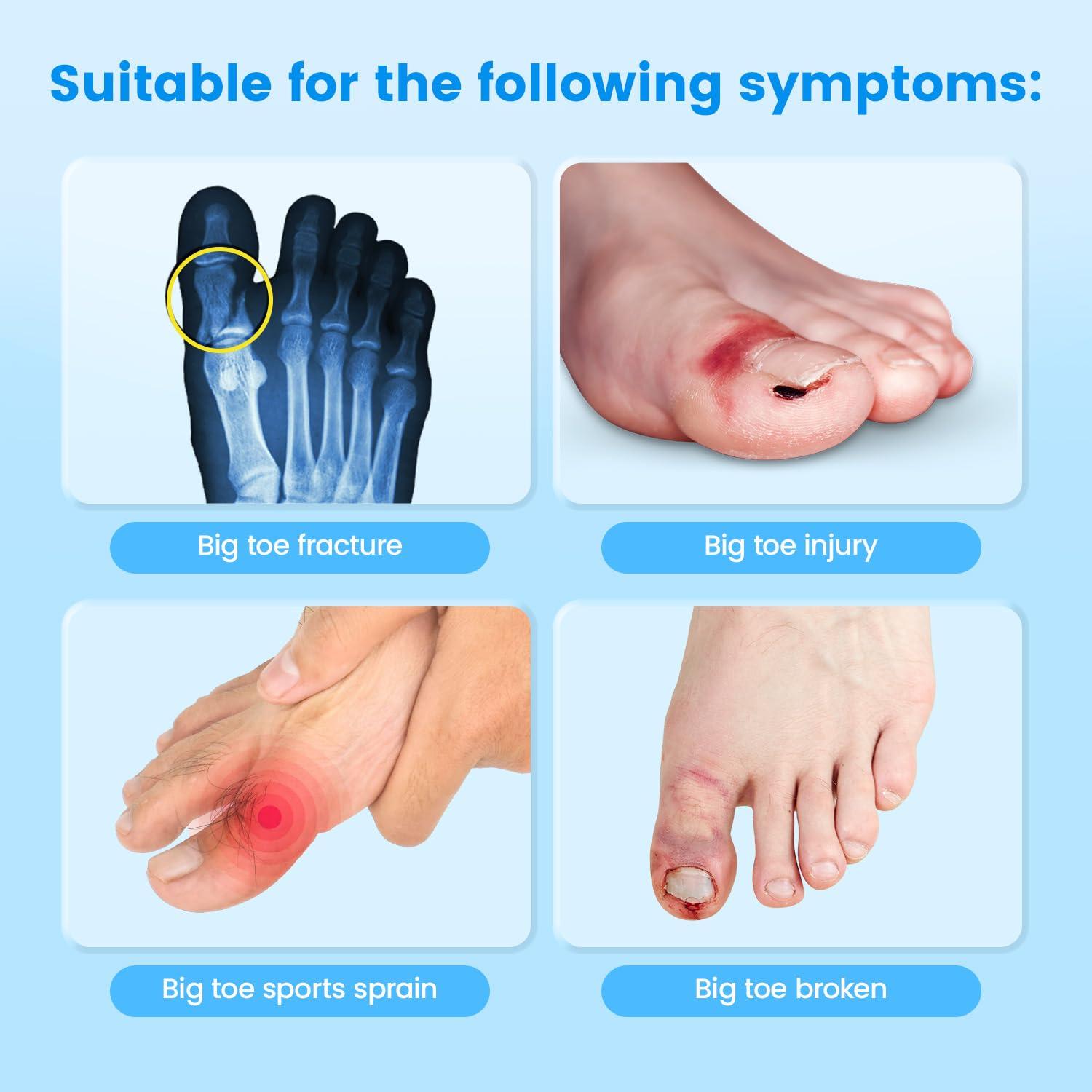 Sylong Broken Big Toe Splint Brace, Fracture Big Toe Protector for Dislocations, Injuries, Sprains, Big Toe Support with 2 Stainless Steel Plate - Right