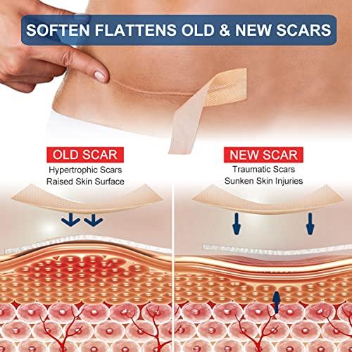 Moulis Silicone Scar Sheets (1.6” x 120” Roll-3M), Silicone Scar Tape Roll, Scar Silicone Strips, Reusable, Professional Scar Removal Sheets for C-Section, Surgery, Burn, Keloid, Acne et