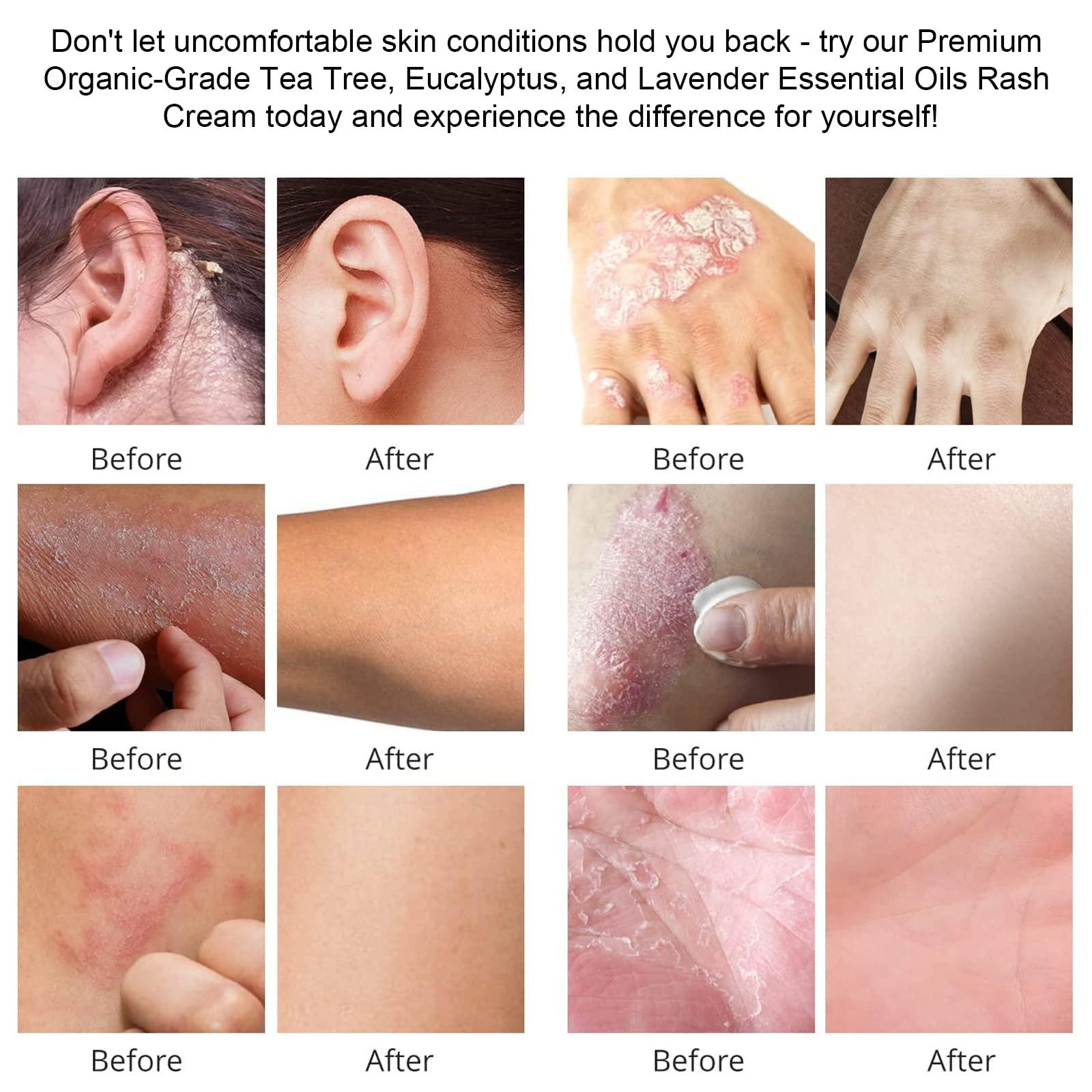 KYMOOU 4 PCS Manuka Honey Tea Tree Drawing Salve Cream Ointment for Boil, Cyst Removal Patch, Splinter Remover, Boil Ease, Ingrown Hair, Chigger, Carbuncle, Pilonidal, Bug, Mosquito, Spider Bites, Bee Sting