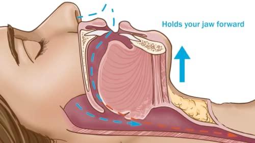 Dentemp Dentemp SleepTight Mouthpiece Anti Snoring Device - Custom Fit Snoring Mouthguard for a Sleep Apnea - Device Designed by Dentist and Made in USA 1pk