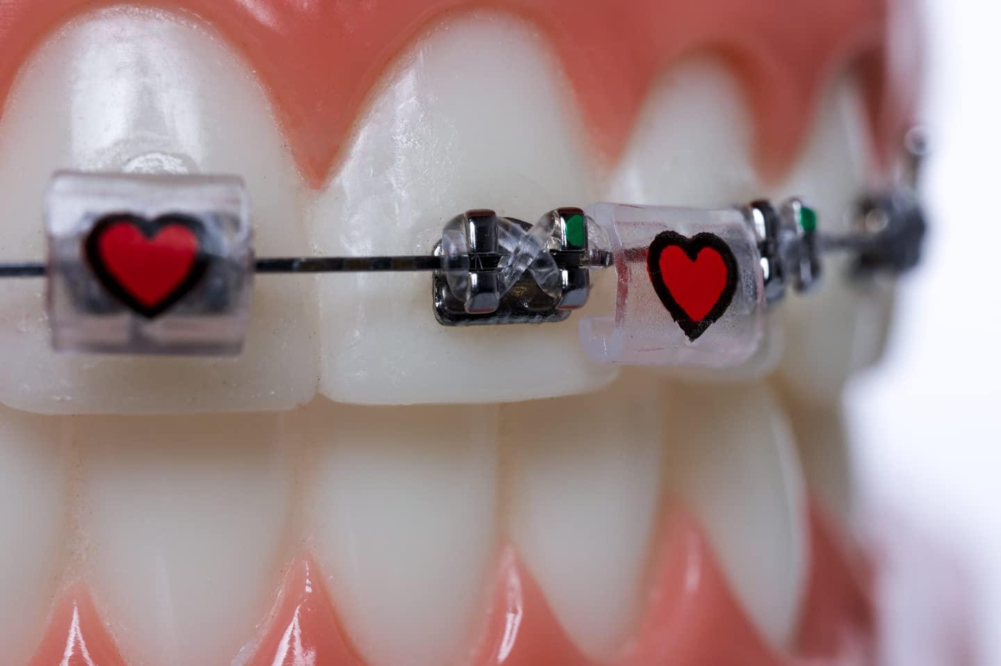 Snapcaps Snapcaps Braces Bumper Cover, Orthodontic Bracket Wax Substitute, Alternative Snap-on Braces Guard Braces Accessories 10 pack (Bow)