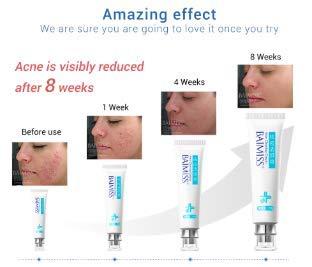 Tink knub BAIMISS Herbal Acne Treatment Cream 1PCS Remove Acne Scar Pimple Face Cream Skin Care Acne Send Removal Needle