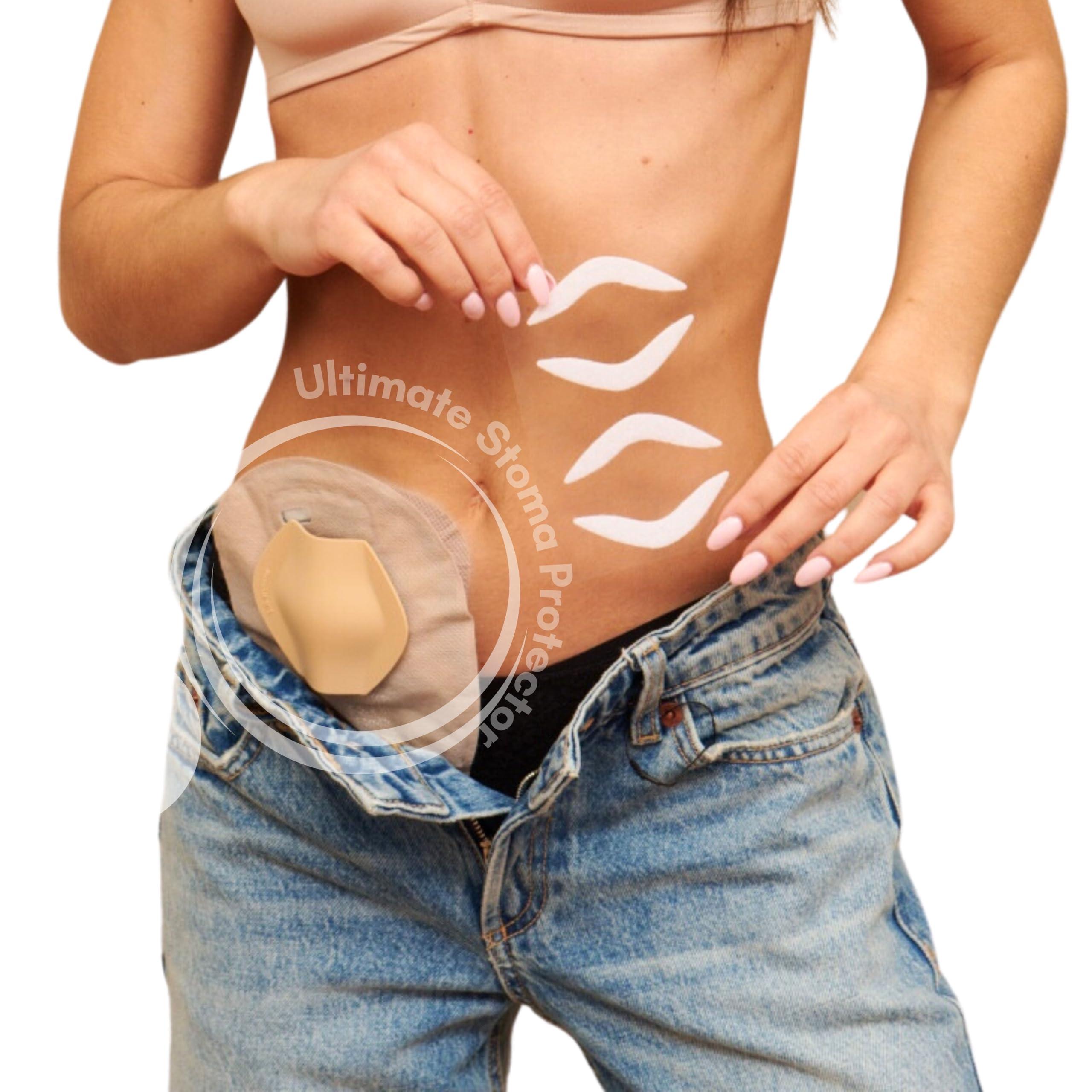 SIIL SIIL Stoma Guard Shield (Beige) for Ostomy bags | Protect your Colostomy Bags & Ileostomy supplies with Stoma Protector | Stoma Cover - Made In Europe