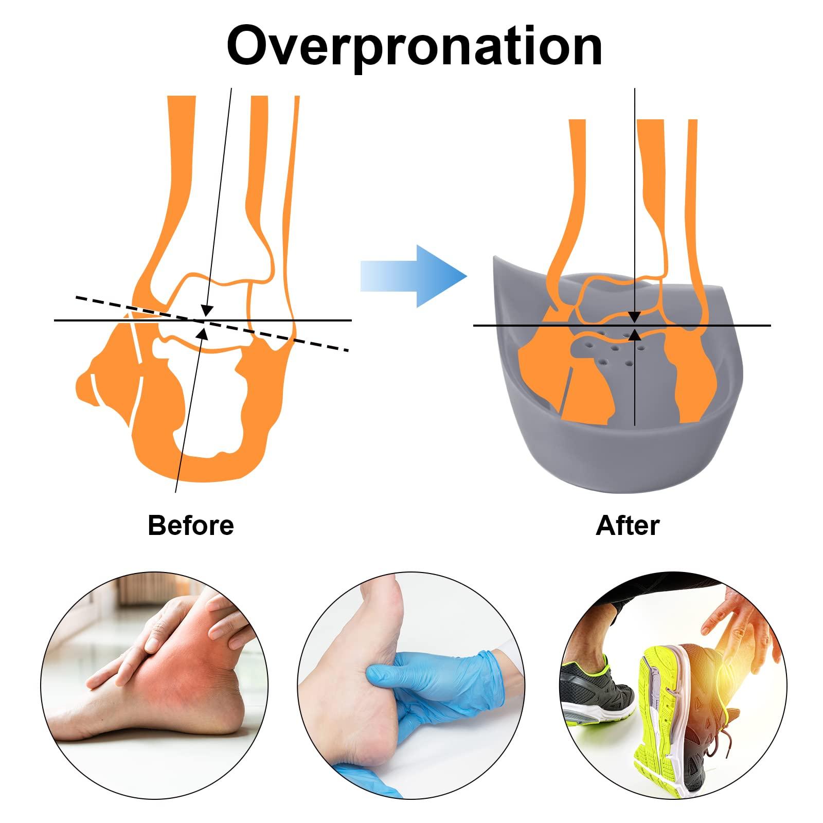 FiotSkep FiotSkep 3/4 Original High Arch Inserts Firm Orthotics for Plantar Fasciitis Flat Feet Over-Pronation, Comfort Metatarsal Pad Support Insoles Relief Heel Spur Pain