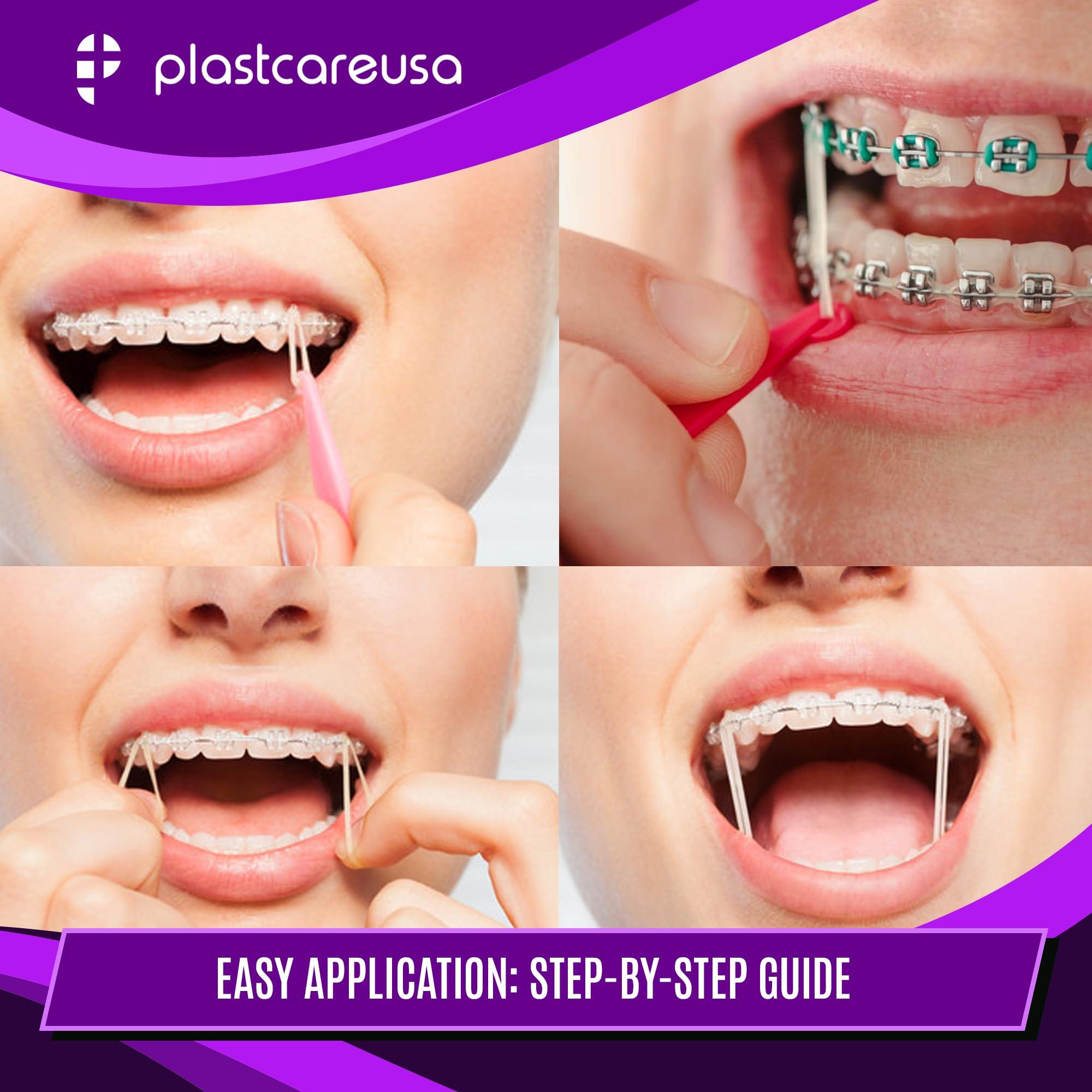 PlastCare USA 1000 Assorted Colors (Light 3.5 Oz, 5/16\" Penguin) Orthodontic Elastic Bands for Braces, Multi-Sized & Multi-Tension Dental Bands for Teeth Alignment, Gap Closure, Latex (10 Bags of 100)