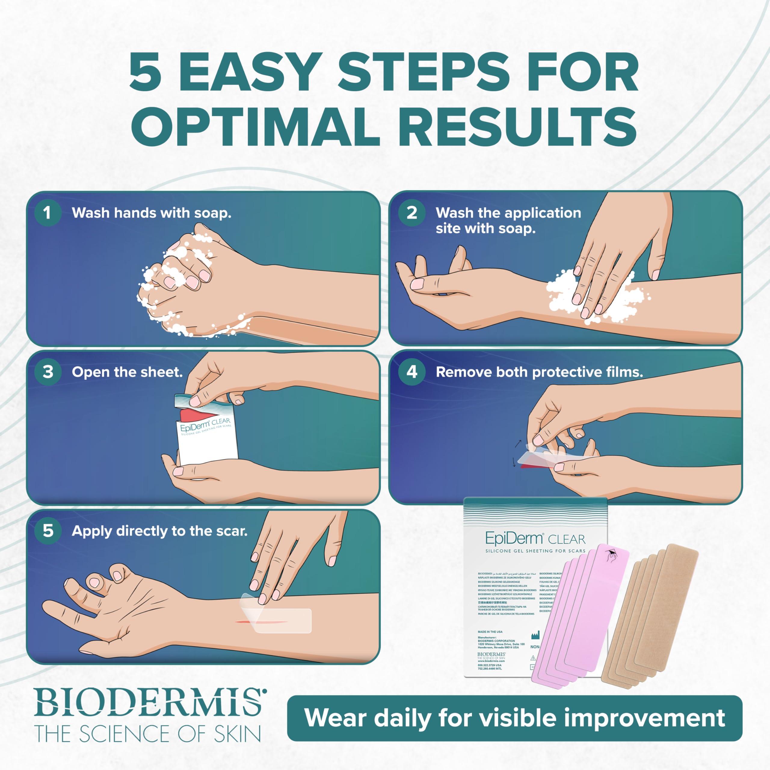 BIODERMIS EpiDerm Silicone Gel Scar Strips - Premium-Grade Silicone Scar Tape for Optimal Scar Care-Versatile, Flexible & Reusable - Ideal for C-Section, Tummy Tuck & Cardiac Surgery Scars - 1.4\"x6\", Clear