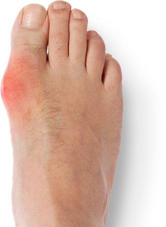 Happystep Happystep 1 Pair Bunion Splint for Hallux Valgus and Bunion Pain Relief & Toe Alignment Adjustable Brace for Men, Women, and Kids, Washable & Durable (Small: women 4-6.5 or big Kid Size 2-4.5)