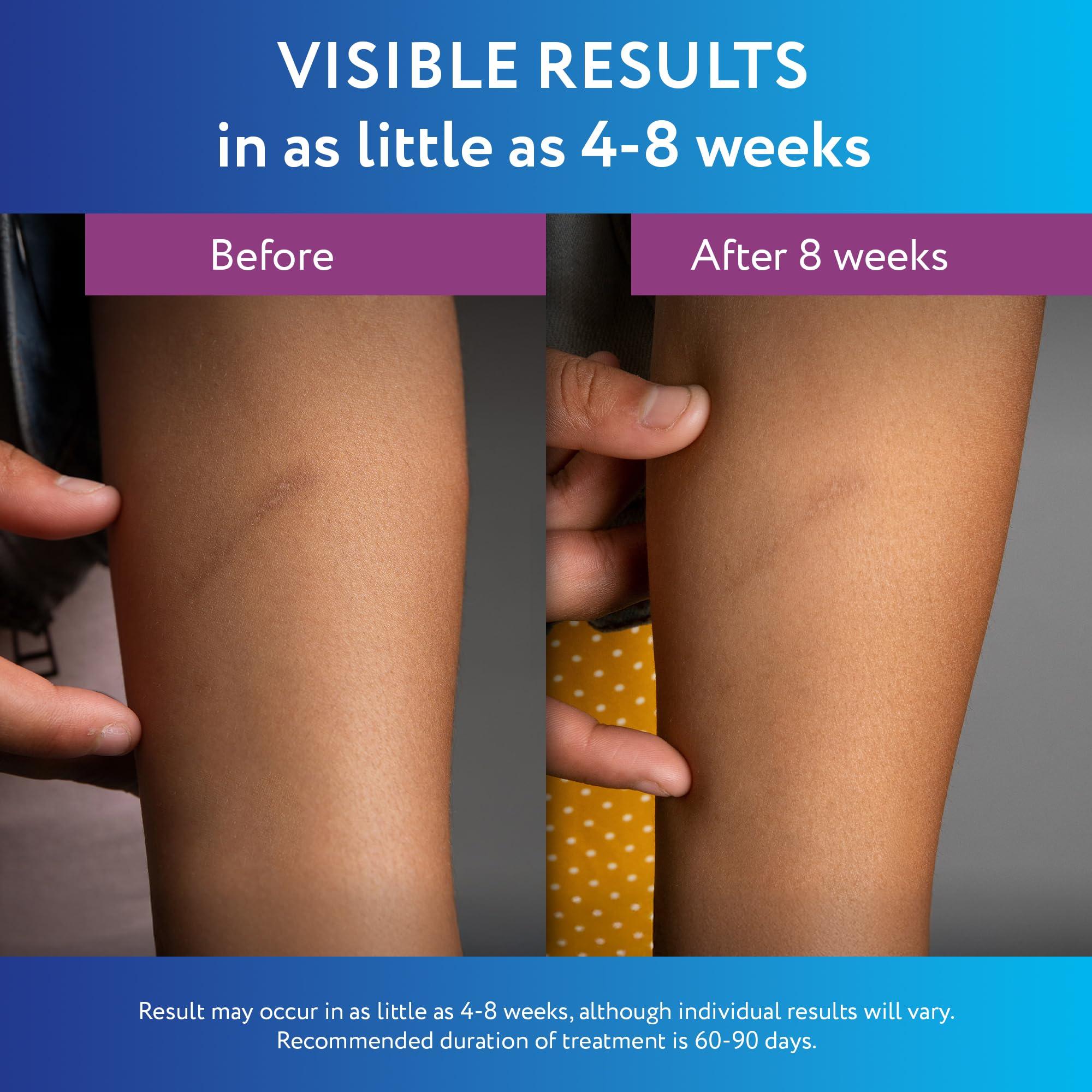 ScarAway ScarAway Silicone Scar Gel, Helps Improve Size, Color & Texture of Hypertrophic & Keloid Scars from Injury, Burns & Surgery, Water Resistant, 10g (0.35 Oz)