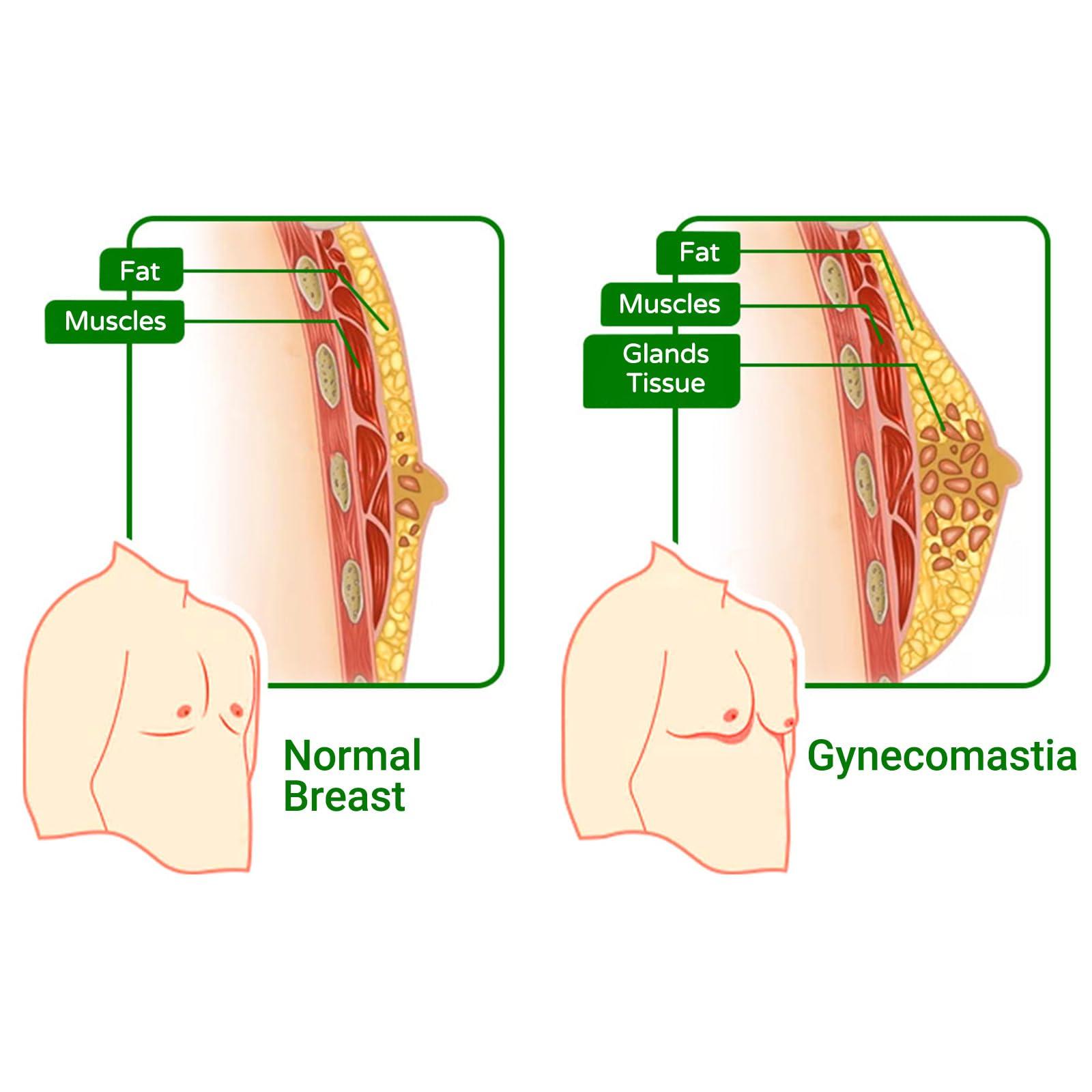 GFOUK Gynecomastia Compress Patch - Ginger Cream for Men, Tightening and Sculpting Chest Muscles with Natural Ingredients (2Pack)