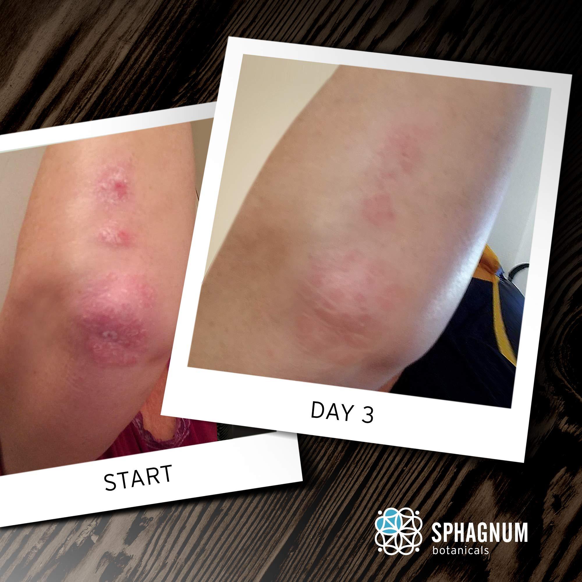 Sphagnum Botanicals Psoriasis Body Wash 100% Natural pH Balancing Acids and Olive Oil Shower Cream. Sulfate Free, Deep Moisturizing Treatment for Very Dry & Itchy Skin. Good for Relieving Eczema. 13.5 fl. Oz