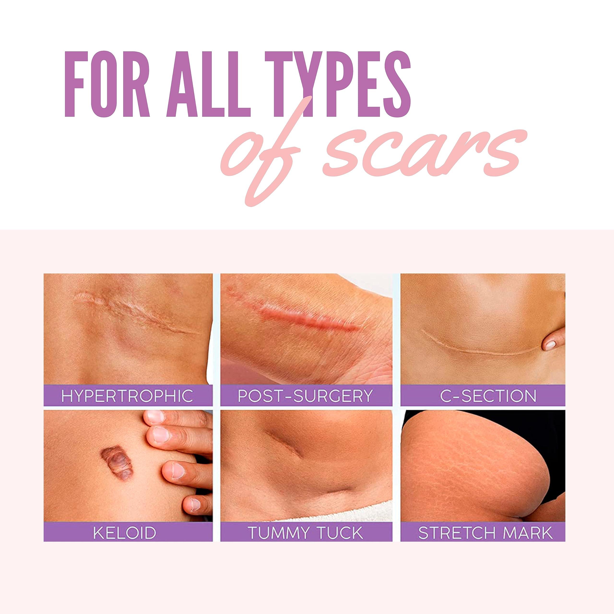 genovie MD Genovie MD Medical Grade Silicone Scar Sheets - Scar Tape Roll Treatment for C-Sections, Keloids, Acne, Post Operative Surgeries, Burns, 6 month Supply, Reusable and Removable Scar Sheets