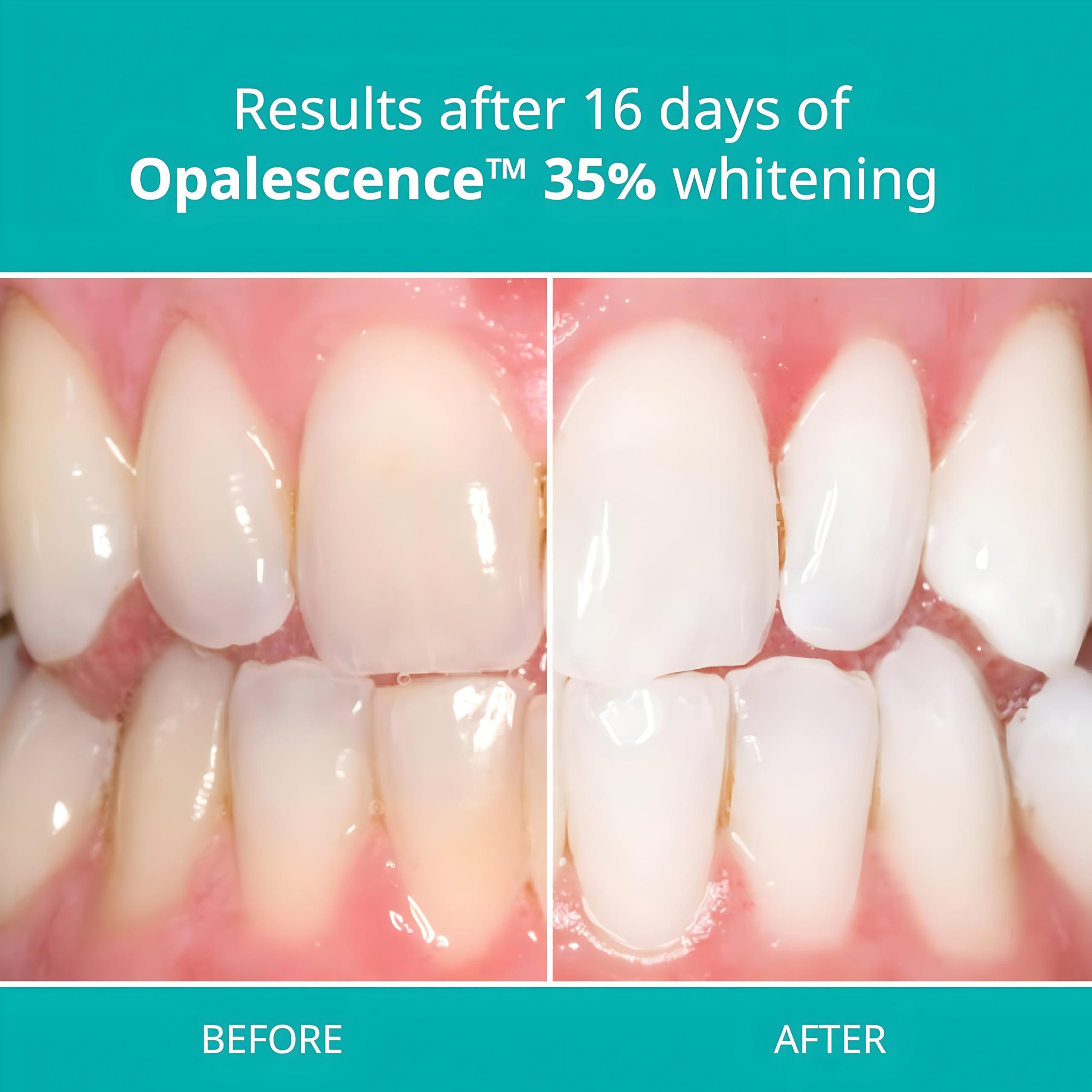 Opalescence Opalescence 35% with PF Gel Syringes Teeth Whitening Refill Kit - 6 Packs / 12 Syringes, Carbamide Peroxide, Melon Flavor by Ultradent 5404-6