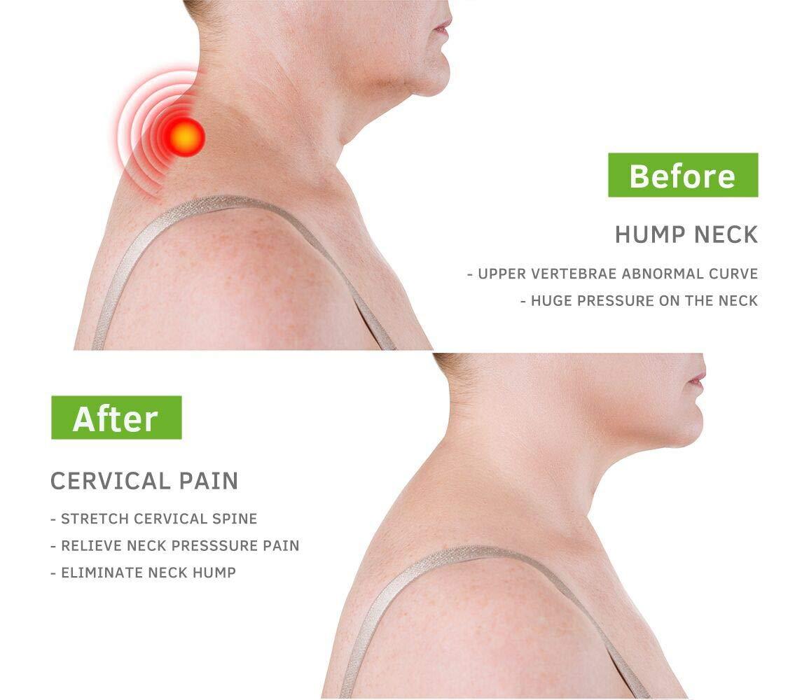 BEIBYE BEIBYE- Upper Back and Headache Pain Relief - treatment for Costochondritis and Tietze Syndromeb-Help Back Stretcher, Posture Corrector