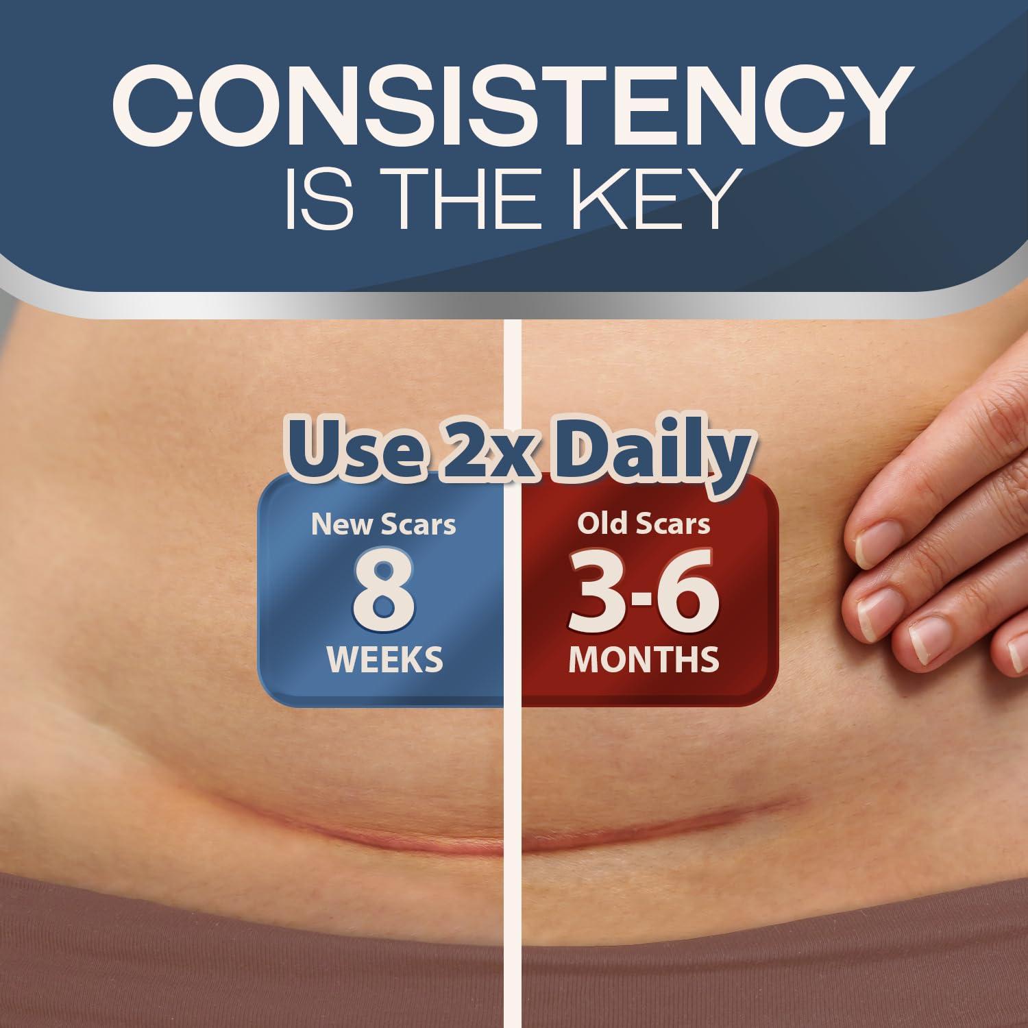 Ebanel Ebanel Advanced Silicone Scar Gel with Allantoin, Emu Oil, Vitamin E and Onion Extract, Medical-Grade Cream for Old & New Scars from Surgeries, C-Section, Injuries, Burns, Keloids & More