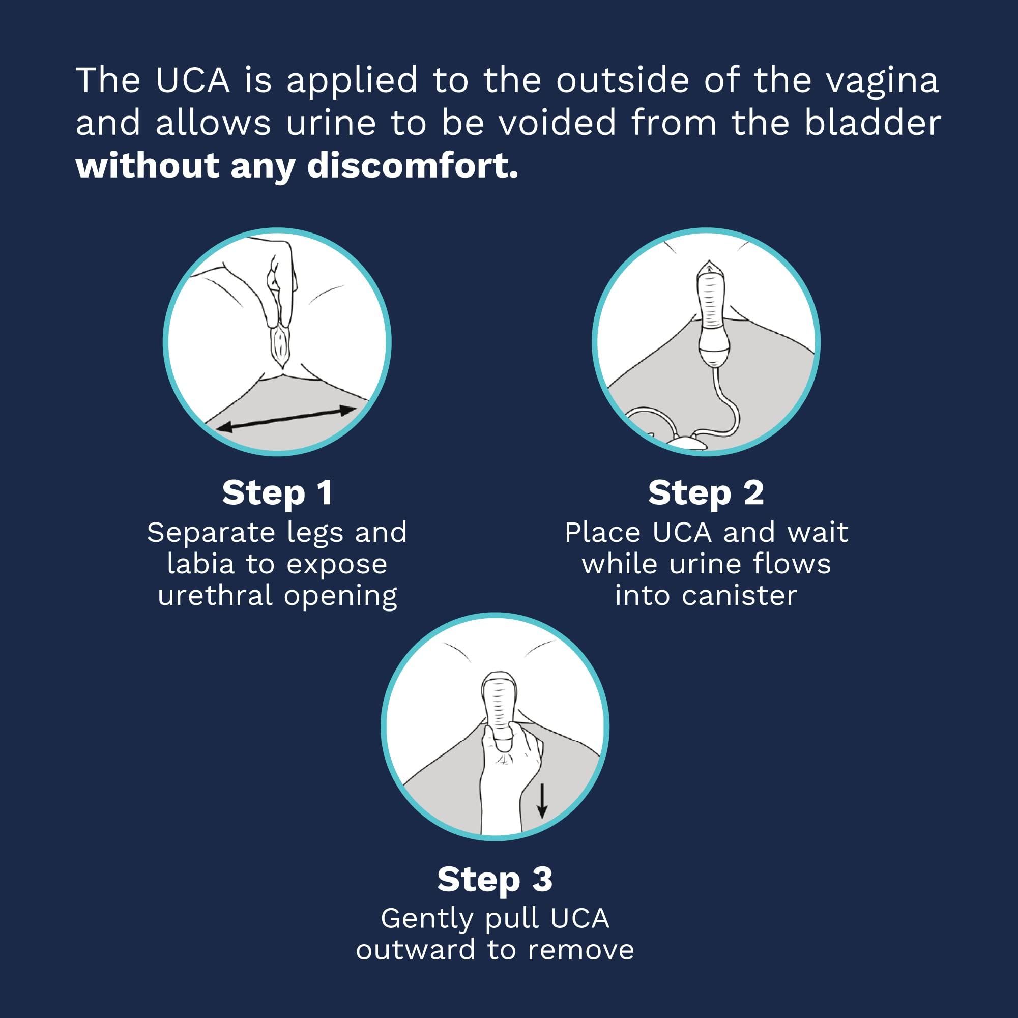 DEMETECH DemeTECH Ur24T F15 Female External Catheter, Catheter Attachment for Aspirator, Bladder-Control Catheter