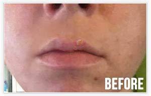 Quick Mend Quickmend Cold Sore Relief Lip Treatment with Pump Dispenser, 4.5 ml / .15 oz.