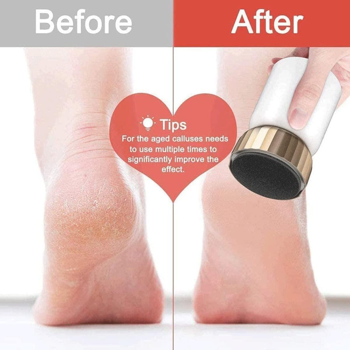 Feilx Feilx Electric Feet Callus Removers Rechargeable, Electronic Foot File Callus Remover, Professional Pedicure Tools, Portable Foot Grinder Foot Care Tool for Dead Skin,Hard Cracked Dry Skin Ideal Gift