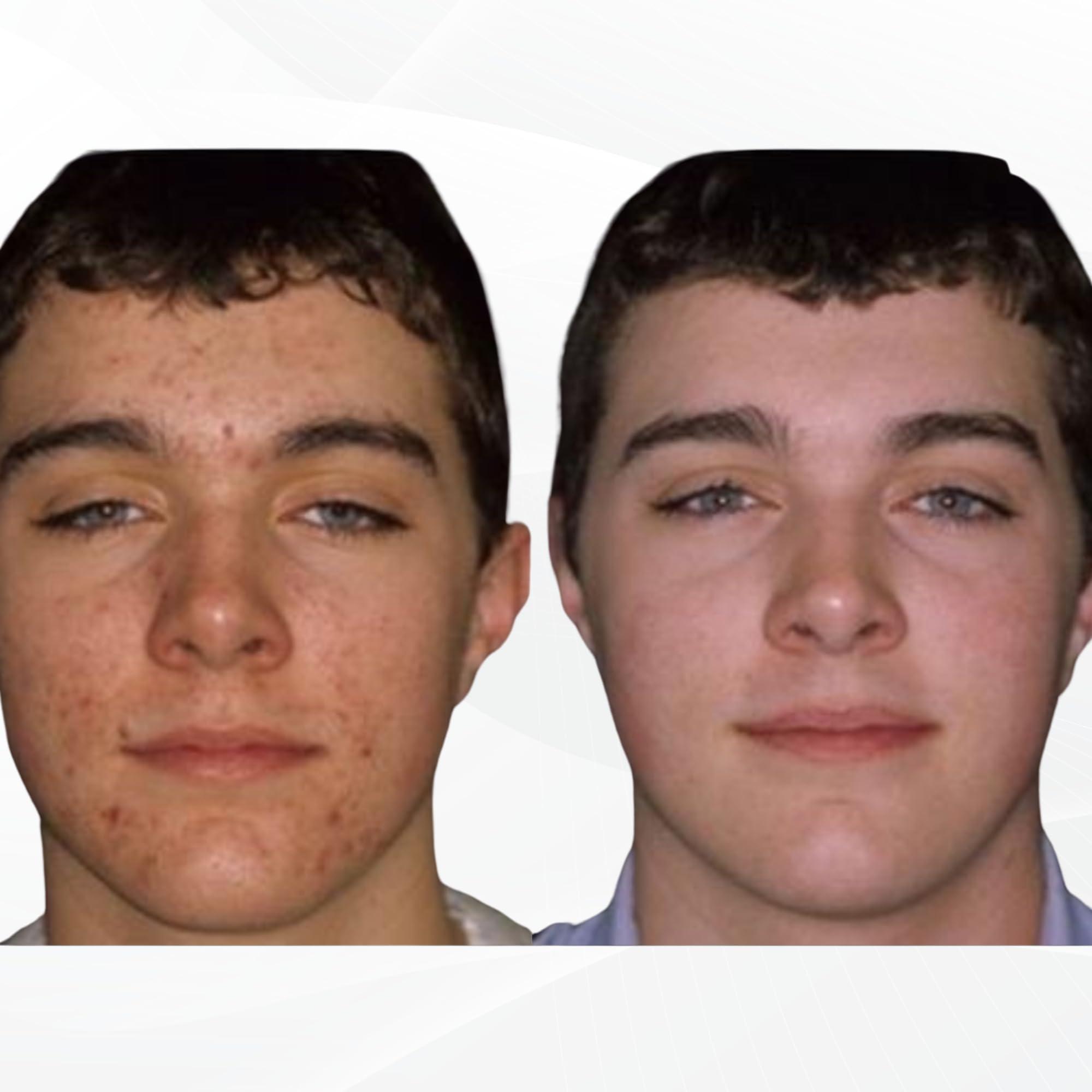 Acnetame Acnetame Acne Pills 30 Day- Supplements for Acne Vitamin Treatment- Tablets to Clear Oily Skin for Women, Men, Teens, and Adults