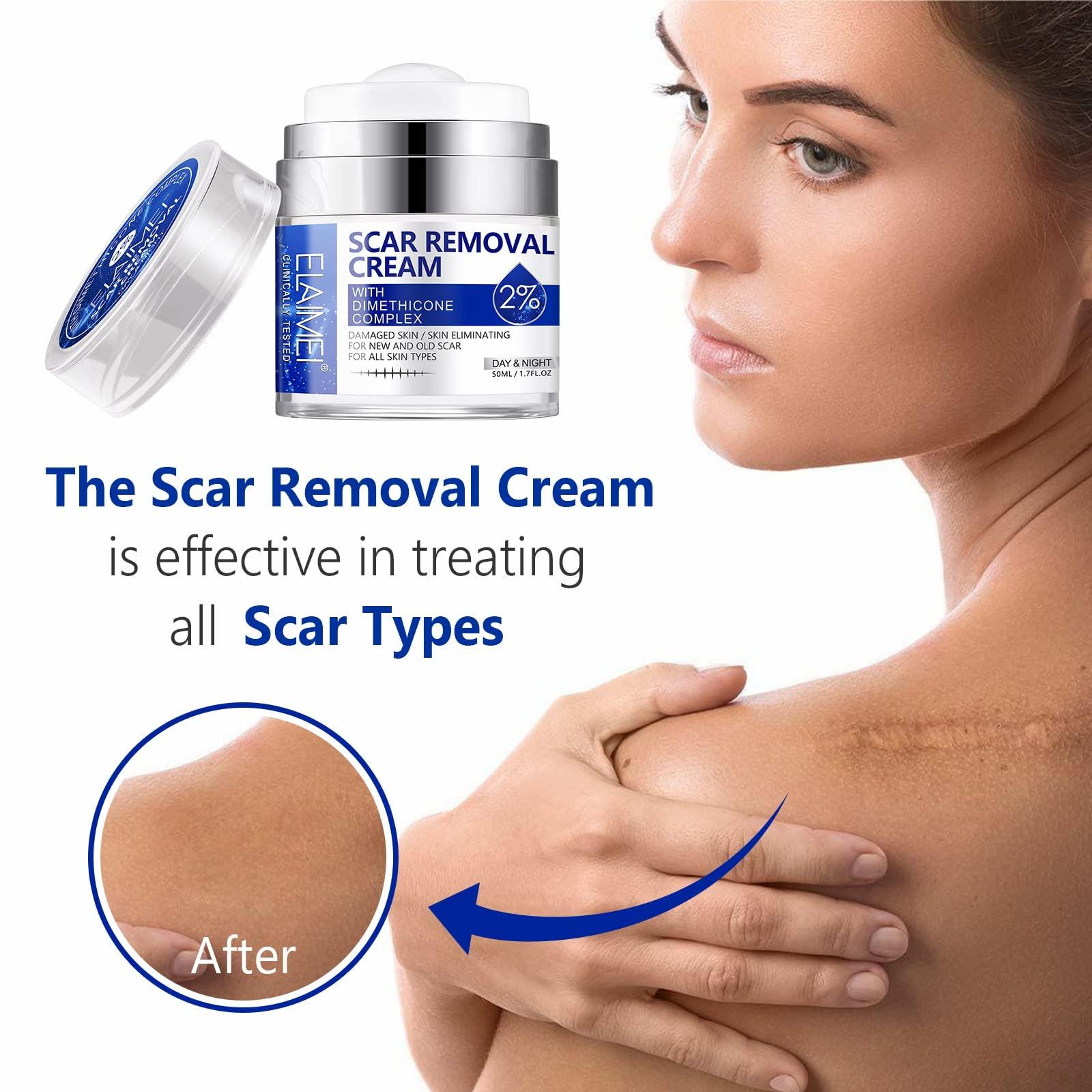 RTBYUE Scar Removal Cream - Advanced Scar Treatment Gel for Surgical Scars, Acne Scars, C-Section, Burns, Stretch Marks - for Old and New Scars