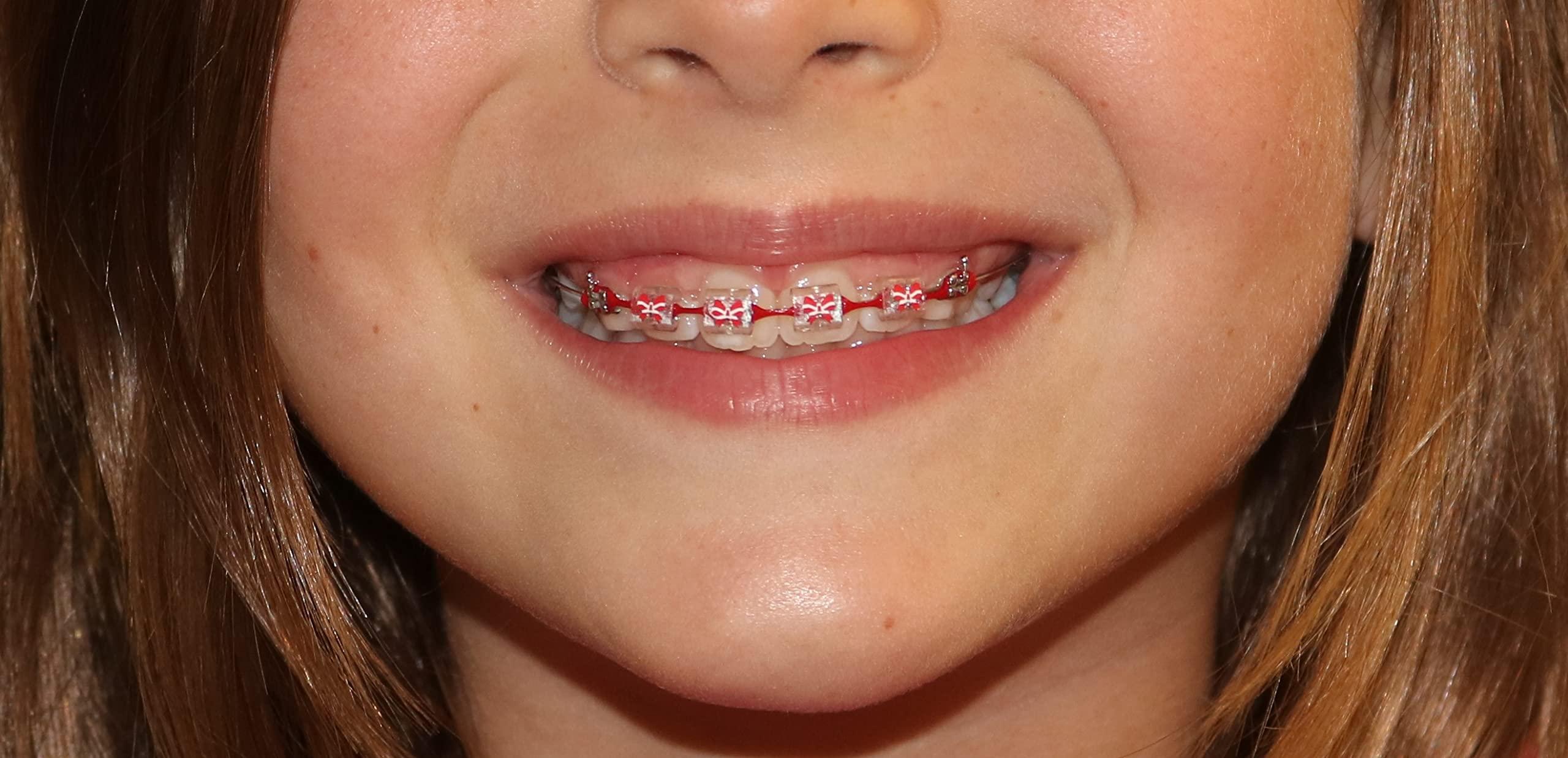 Snapcaps Snapcaps Braces Bumper Cover, Orthodontic Bracket Wax Substitute, Alternative Snap-on Braces Guard Braces Accessories 10 pack (Bow)