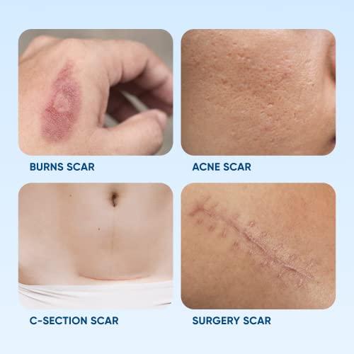 Serica Scar Gel Advanced Silicone Formula, Visibly Reduces the Appearance of Scars from Surgery, Acne, Injuries. Clinically Proven Results 1oz.