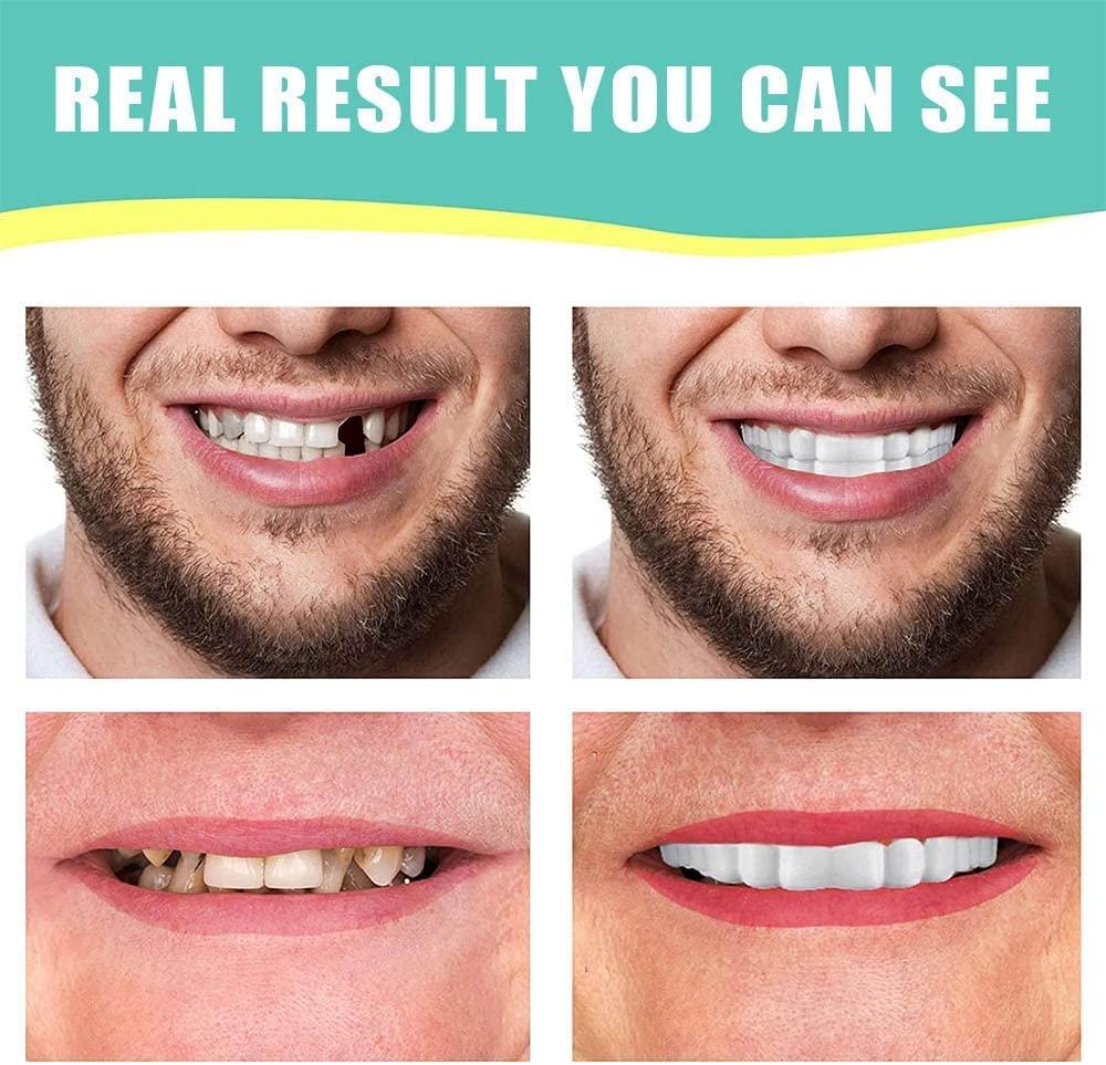 SHxxyljh 1Set Dentures Veneers Tooth,Dental Care Kits for Anti Molar Orthodontic Cosmetic Teeth,Smile Snap Tooth.(White,1Top+ 1Bottom+2Adhesives+1Tweezers+1Heart-Shaped Storage Box