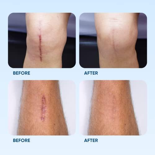 Serica Scar Gel Advanced Silicone Formula, Visibly Reduces the Appearance of Scars from Surgery, Acne, Injuries. Clinically Proven Results 1oz.