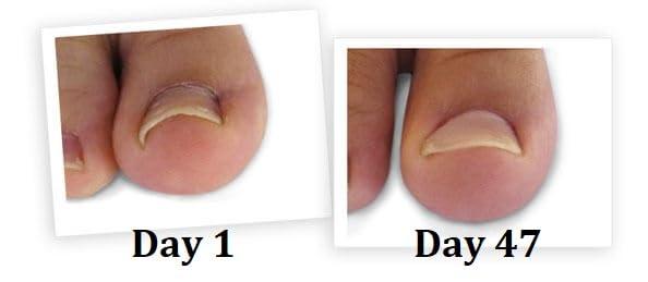 CurveCorrect CurveCorrect Ingrown Toenail Home Treatment | Ingrown toenail Correction kit, Includes Ten Standard toenail Braces.