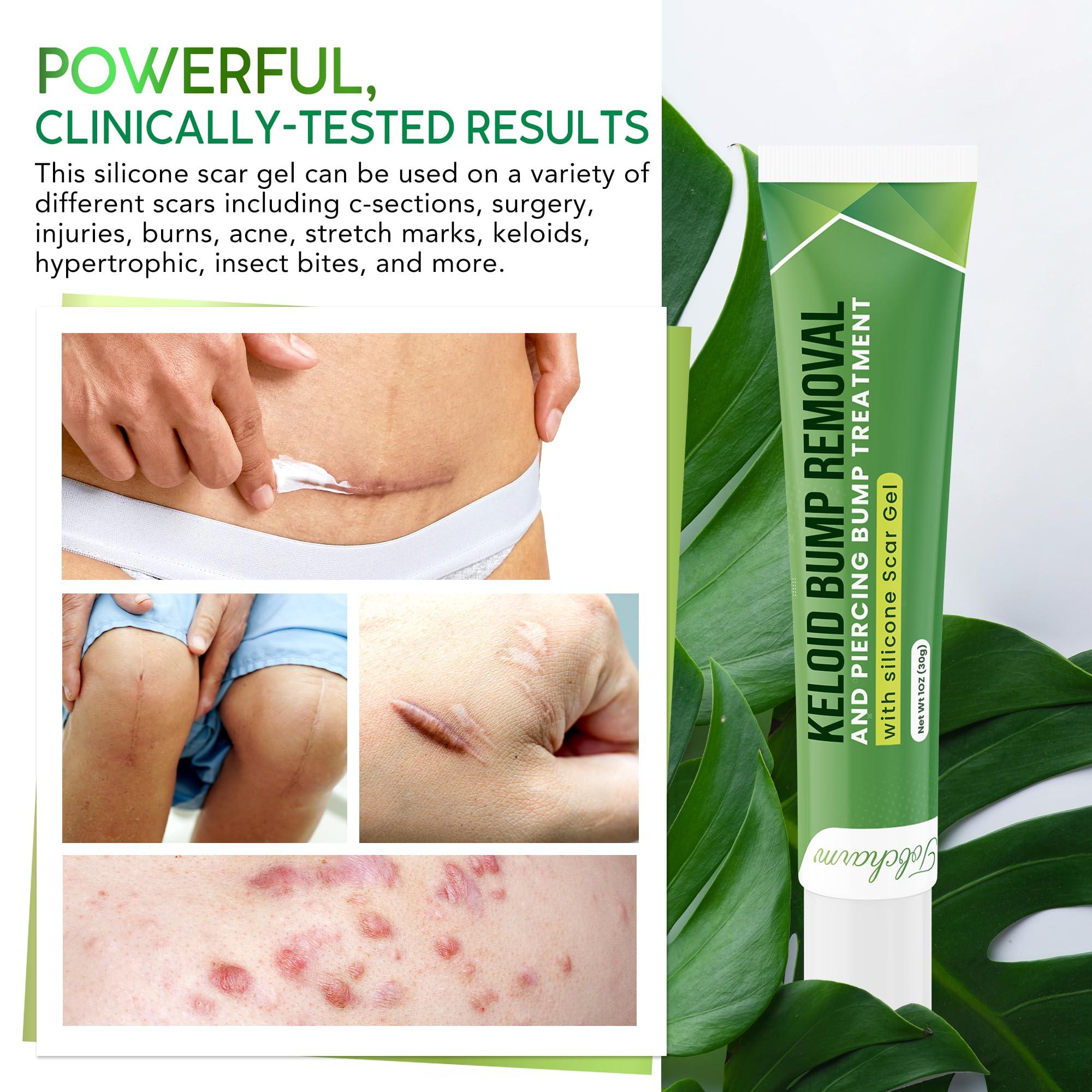Tobcharm Advanced Keloid Bump Removal Gel: Silicone Keloid Scar Removal Cream for Scars from Piercing, Surgical Marks, Acne, and Burns, Keloid Treatment for Ears, Face, and Body with Healing Formula 30g