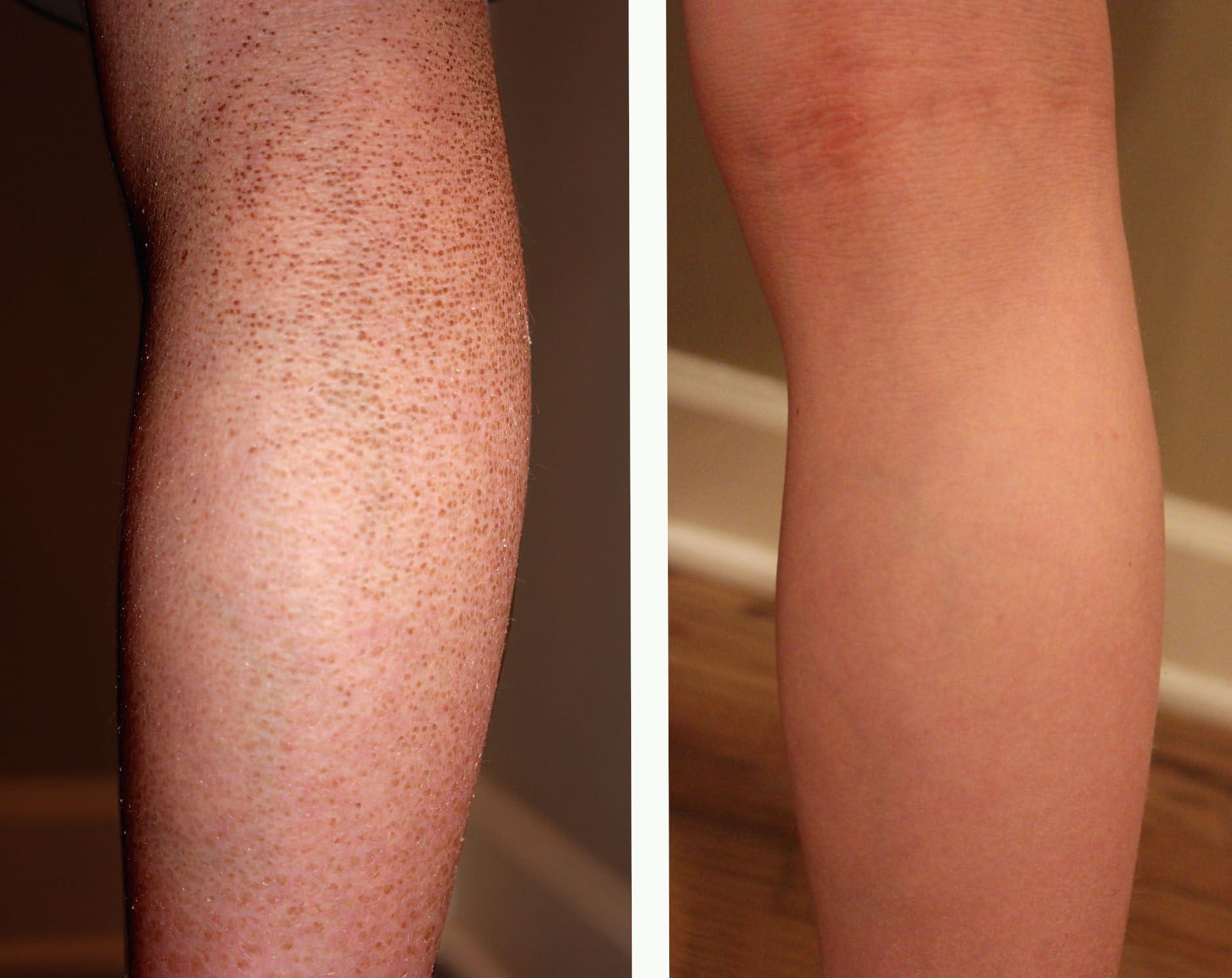 G16 Lotion G16 Skin Repair, Very Dry Skin & Ichthyosis Treatment Cream & Lotion