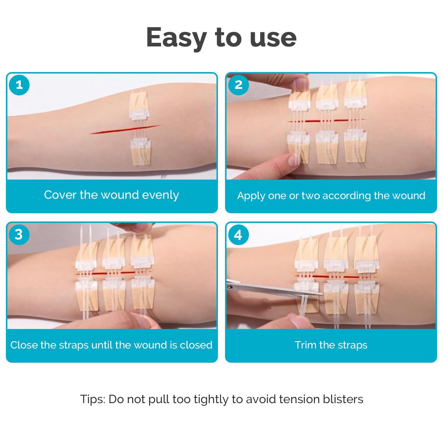 Greetmed Emergency Wound Closure Device 10 Pcs Zip Stitch Wound Closure Strips Laceration Kit Sutures Bandaids for Wounds Repair Without Sew Quick Clot First Aid Wound Care for Outdoor Hiking